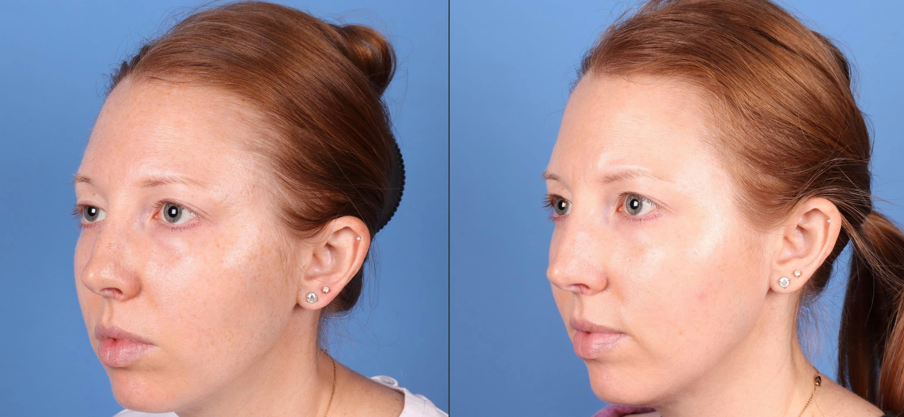 Droopy Eyelid Repair (Ptosis) Before & After Gallery - Patient 271768 - Image 4
