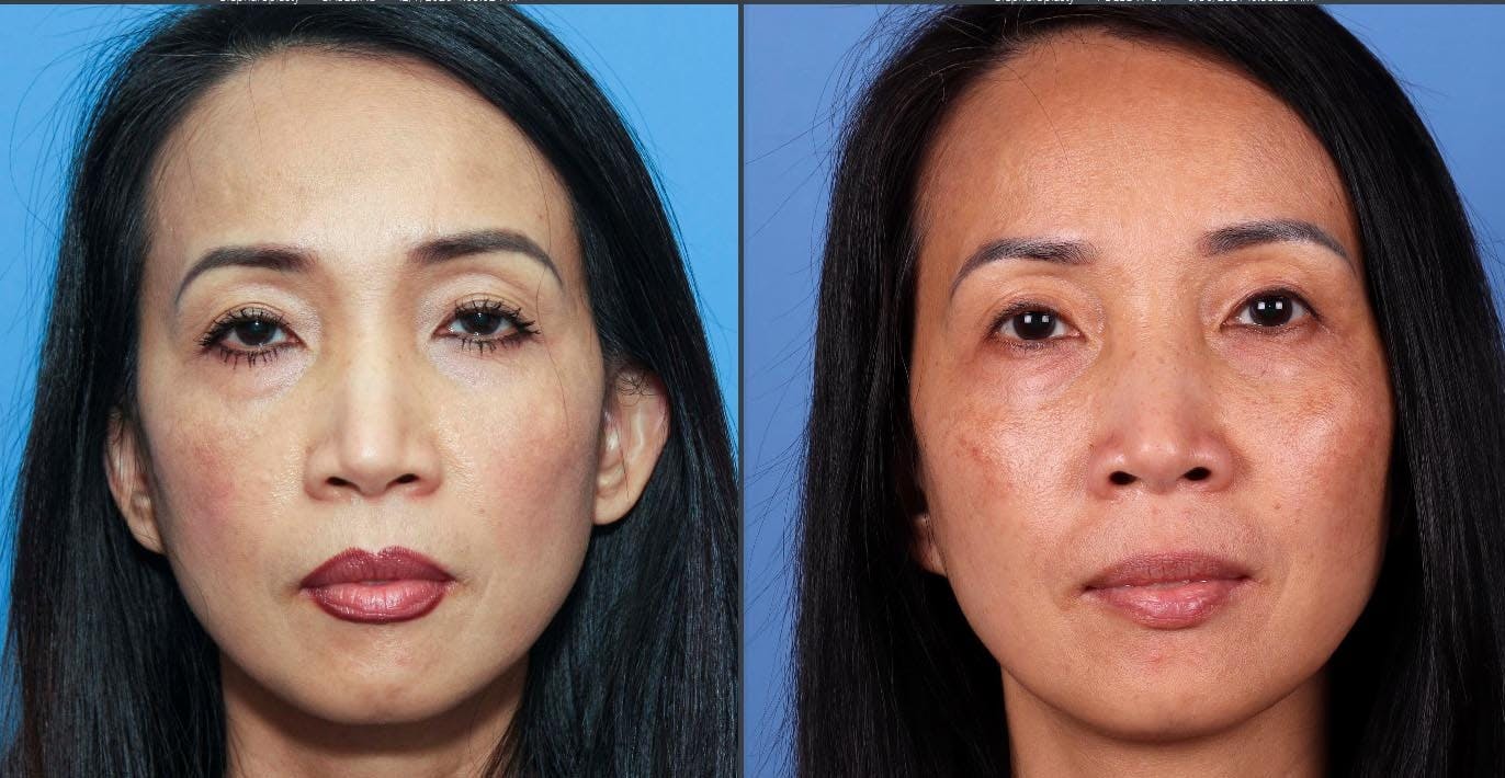 Droopy Eyelid Repair (Ptosis) Before & After Gallery - Patient 343692 - Image 1