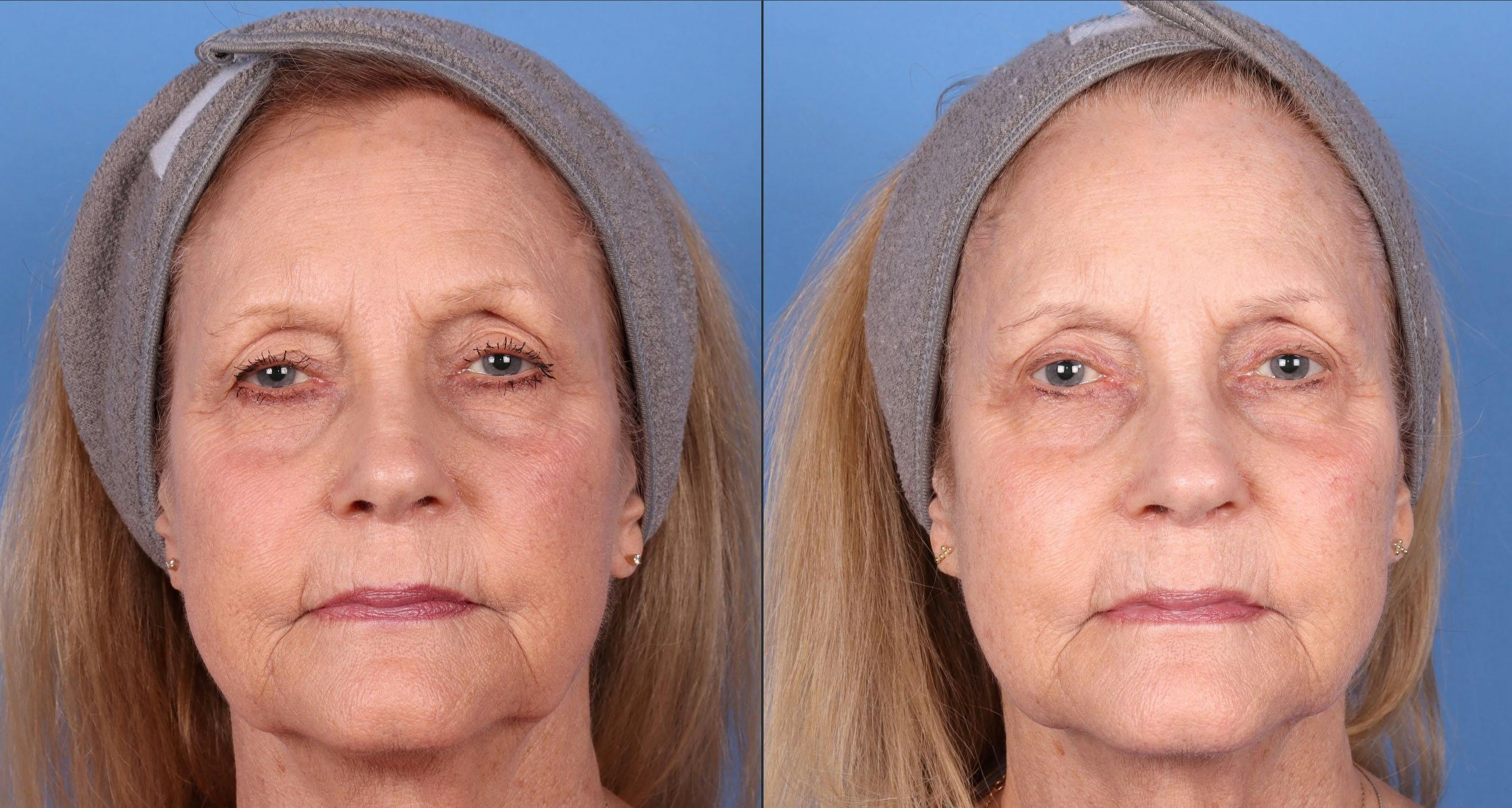 Droopy Eyelid Repair (Ptosis) Before & After Gallery - Patient 221014 - Image 1