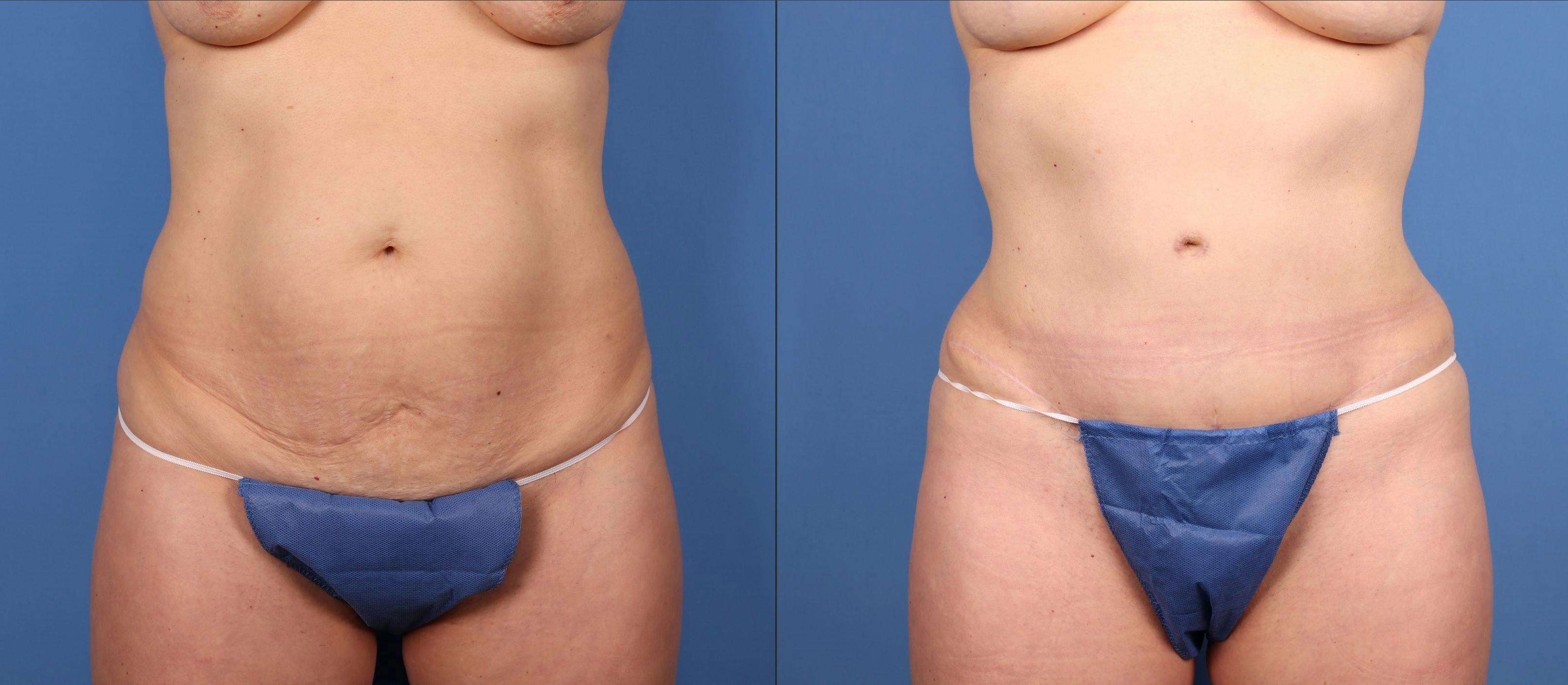 Tummy Tuck Before & After Gallery - Patient 322350 - Image 1