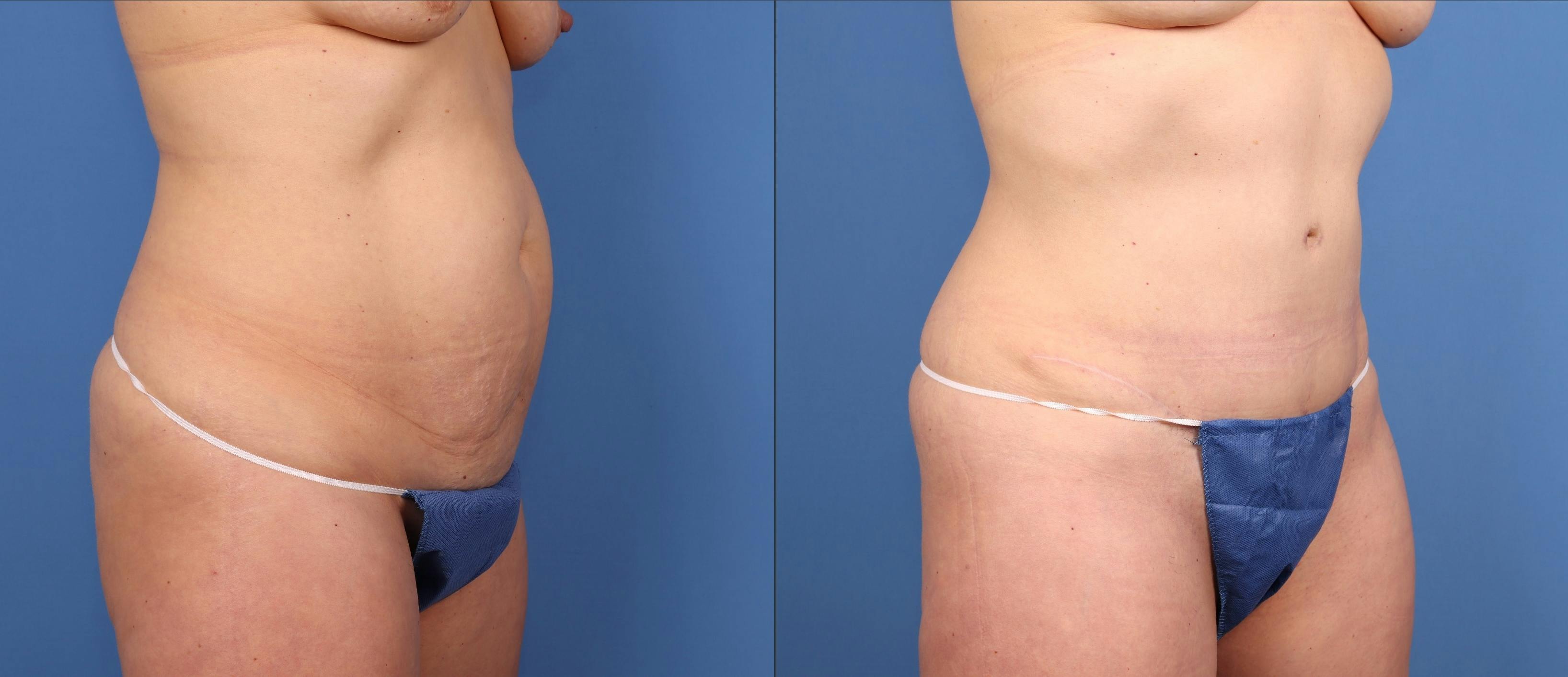 Tummy Tuck Before & After Gallery - Patient 322350 - Image 2
