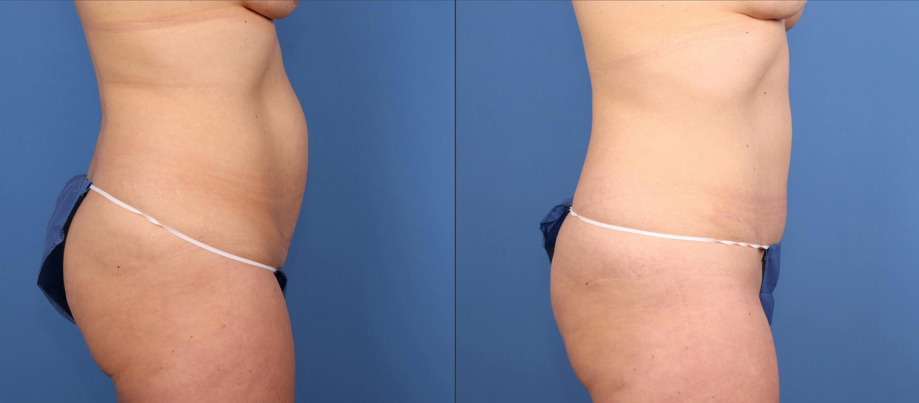 Tummy Tuck Before & After Gallery - Patient 322350 - Image 3