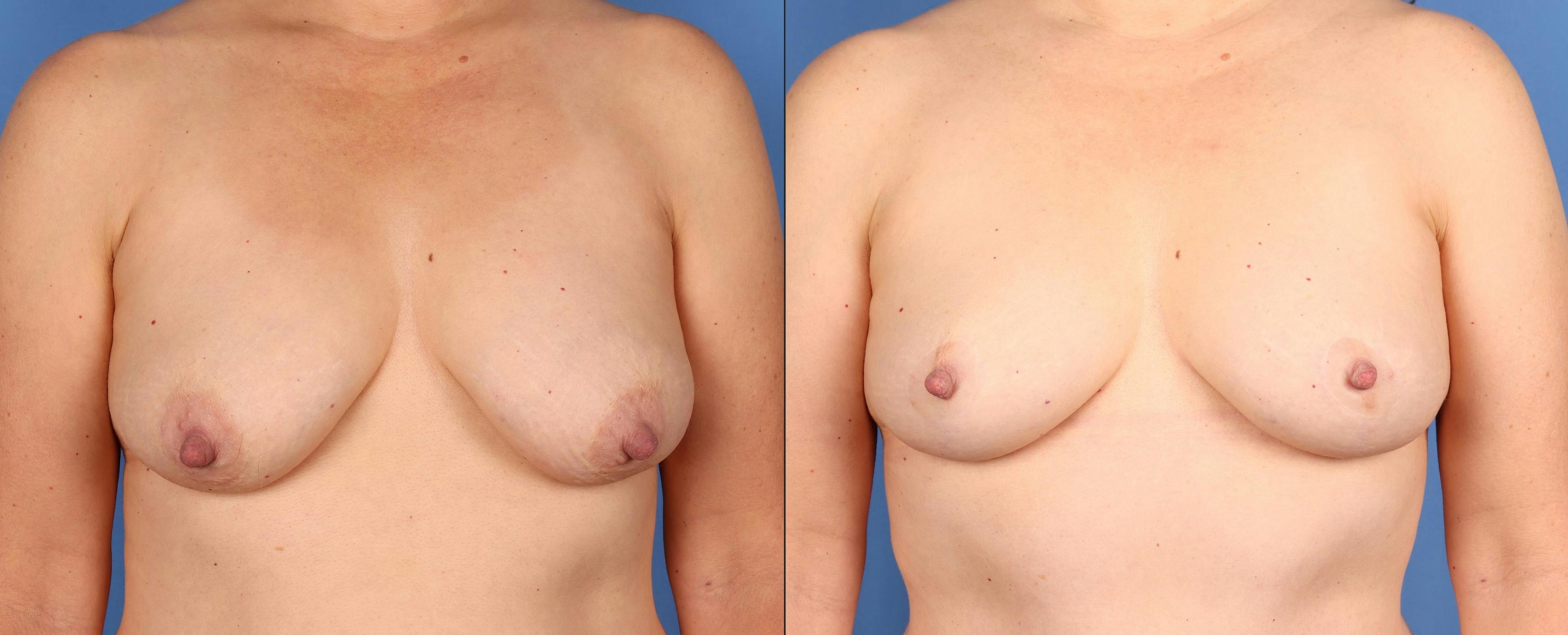Breast Lift Before & After Gallery - Patient 133188 - Image 1