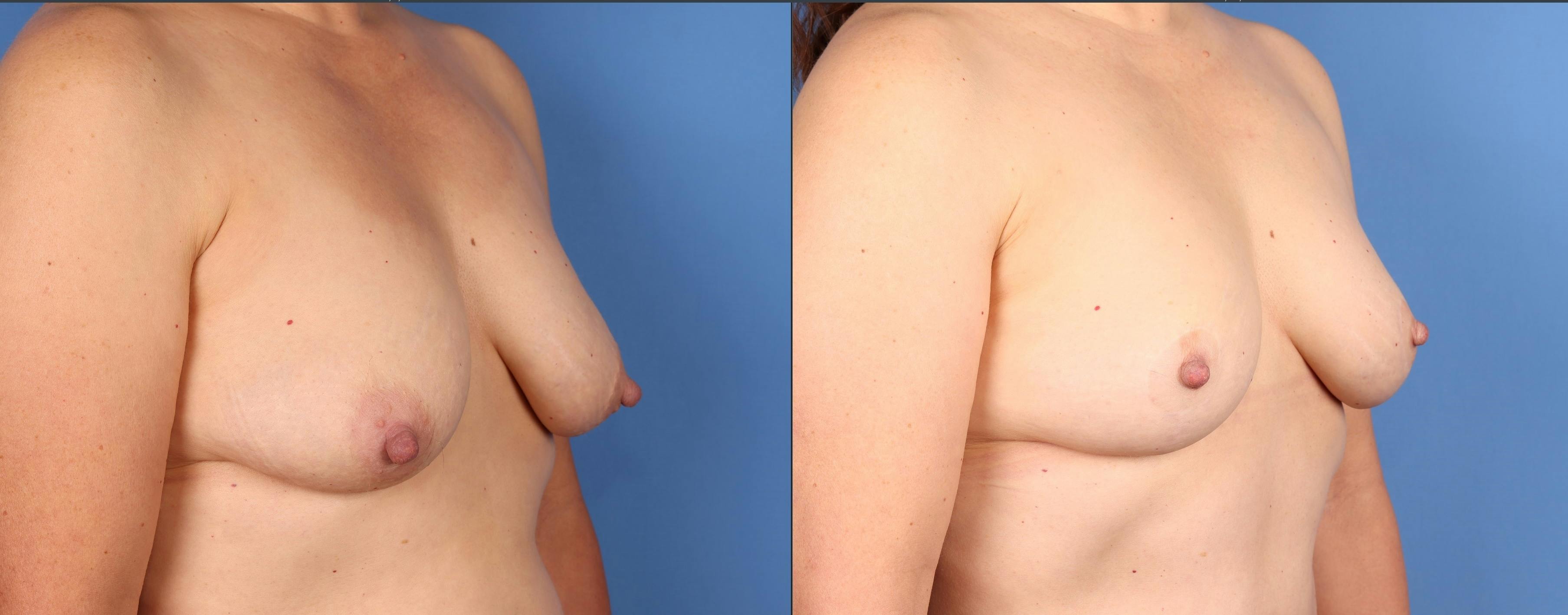 Breast Lift Before & After Gallery - Patient 133188 - Image 2