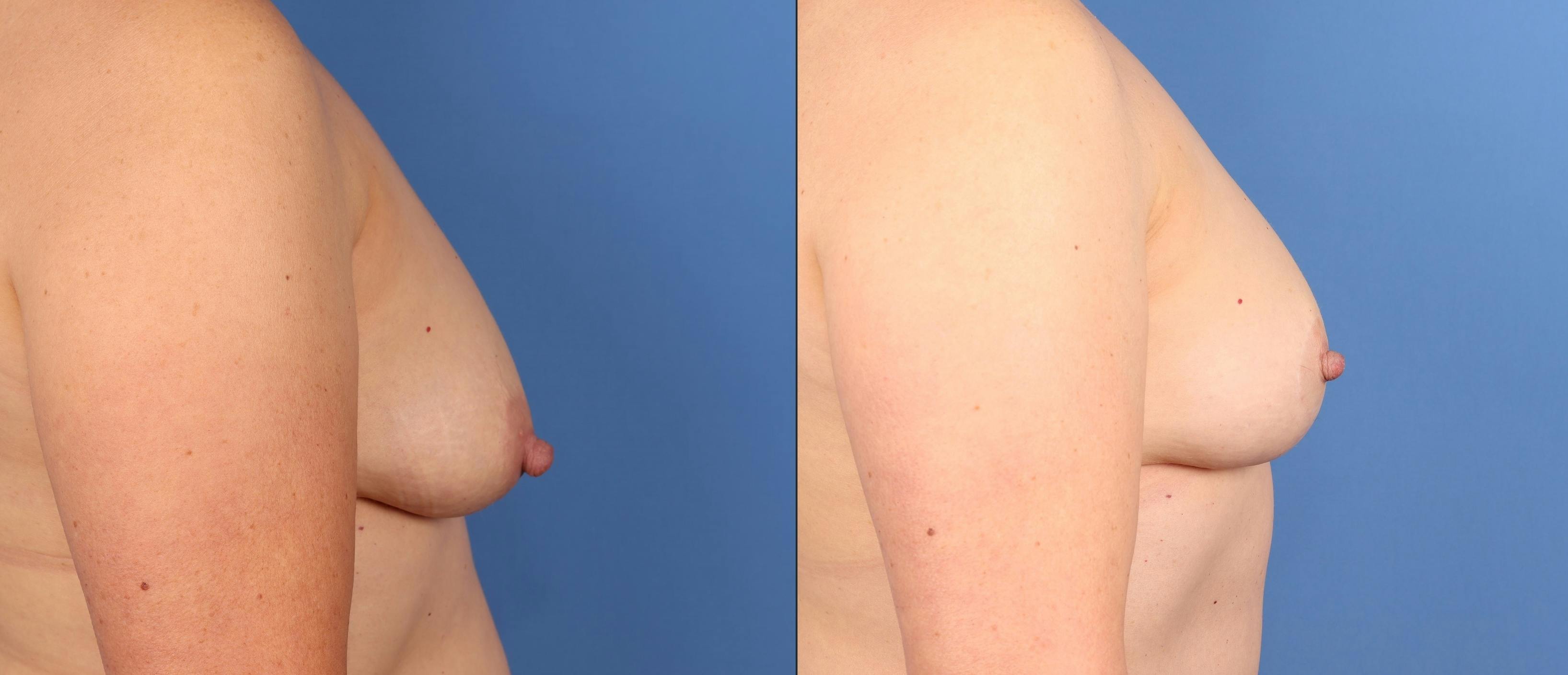 Breast Lift Before & After Gallery - Patient 133188 - Image 3