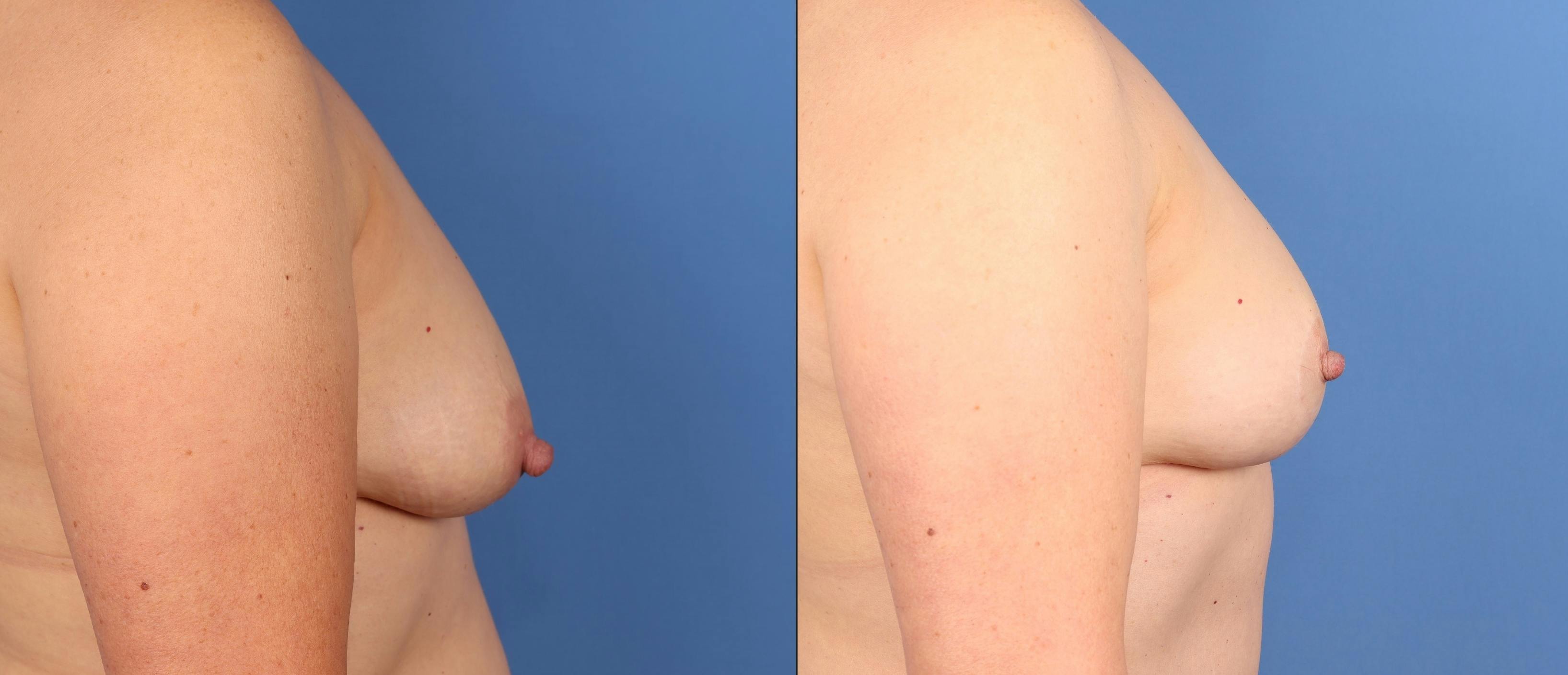 Breast Lift Before & After Gallery - Patient 133188 - Image 3