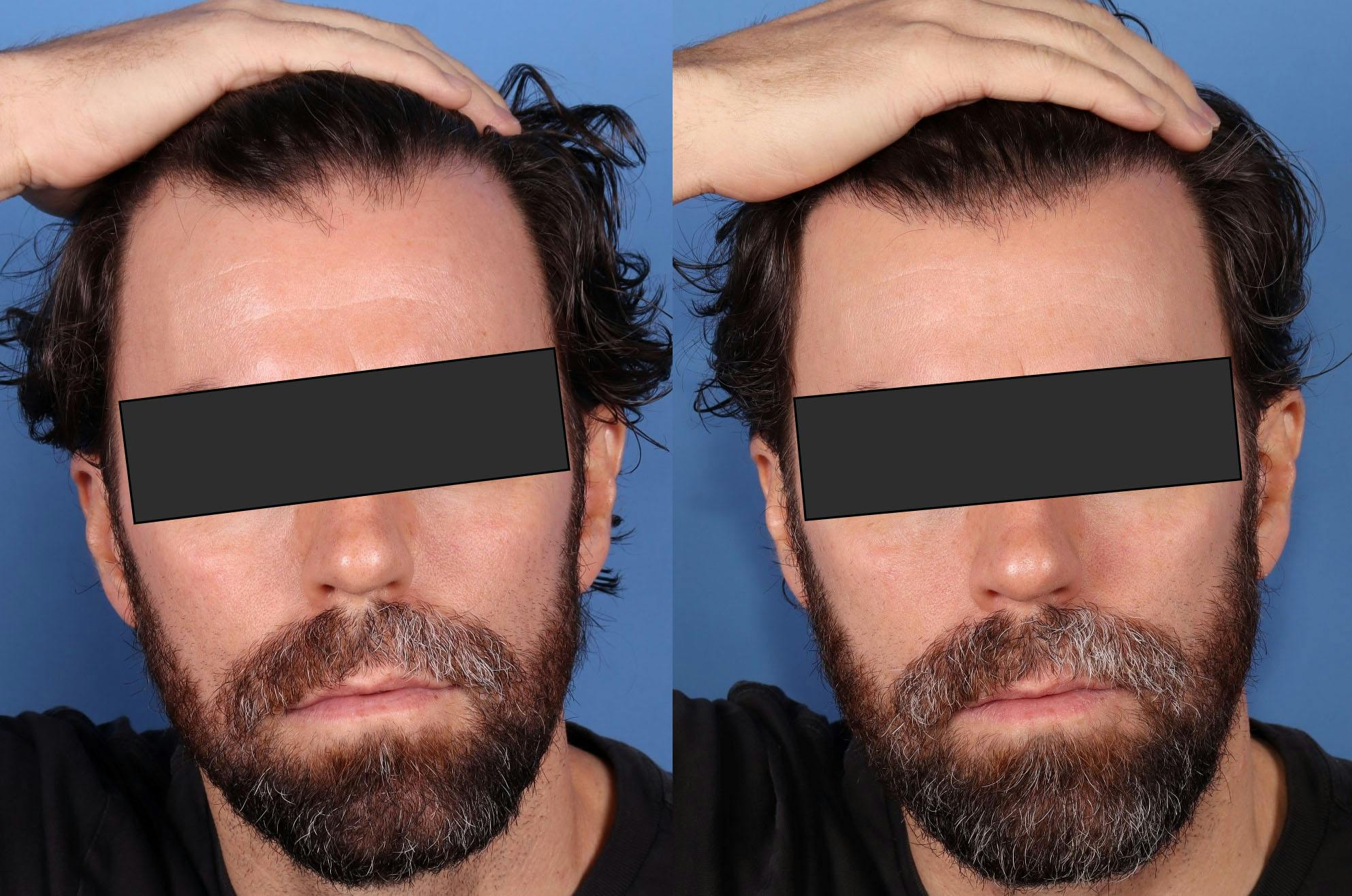 NeoGraft Hair Restoration Before & After Gallery - Patient 386851 - Image 1