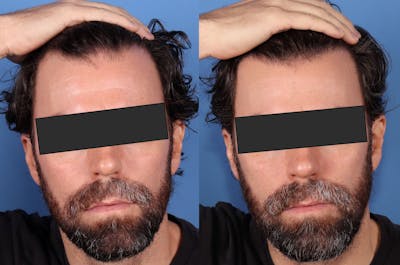 NeoGraft Hair Restoration Before & After Gallery - Patient 386851 - Image 1