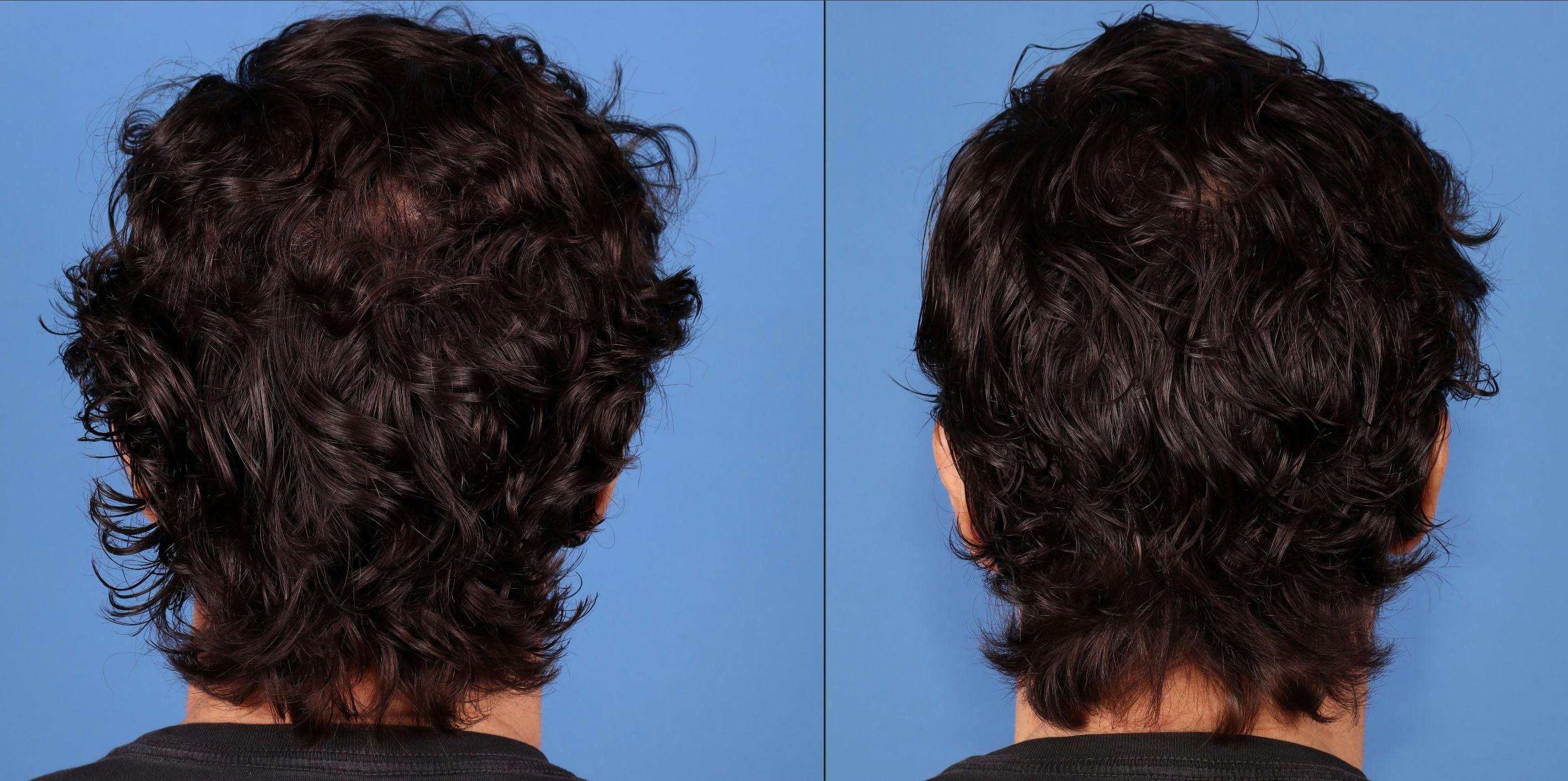 NeoGraft Hair Restoration Before & After Gallery - Patient 386851 - Image 3