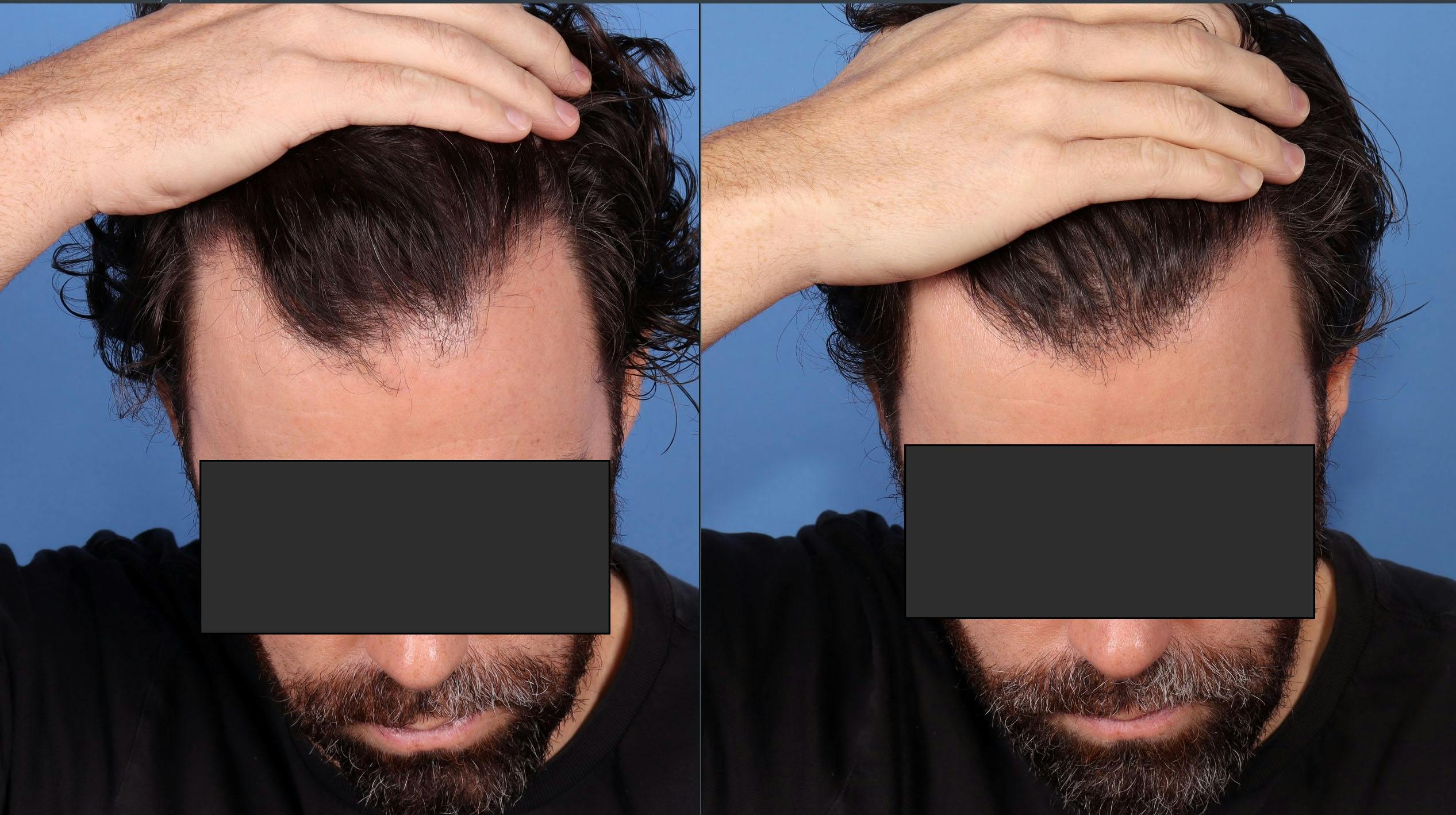 NeoGraft Hair Restoration Before & After Gallery - Patient 386851 - Image 2