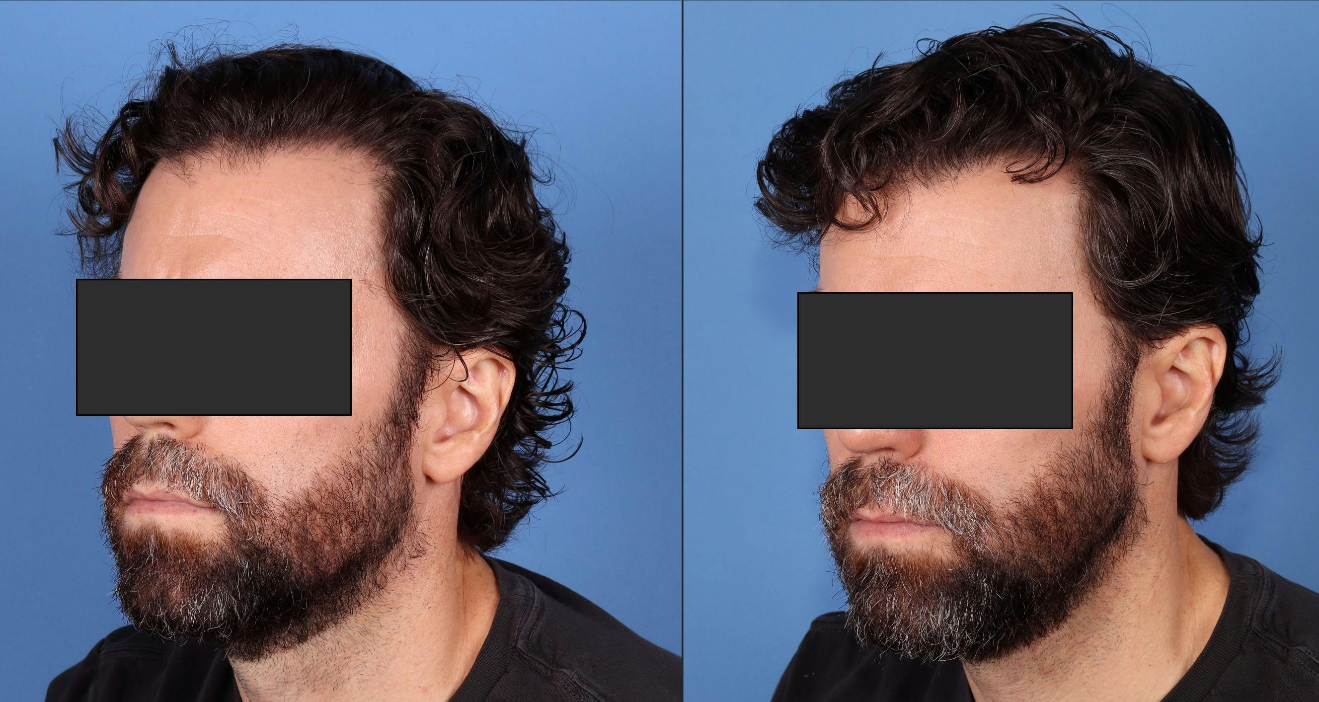 NeoGraft Hair Restoration Before & After Gallery - Patient 386851 - Image 4