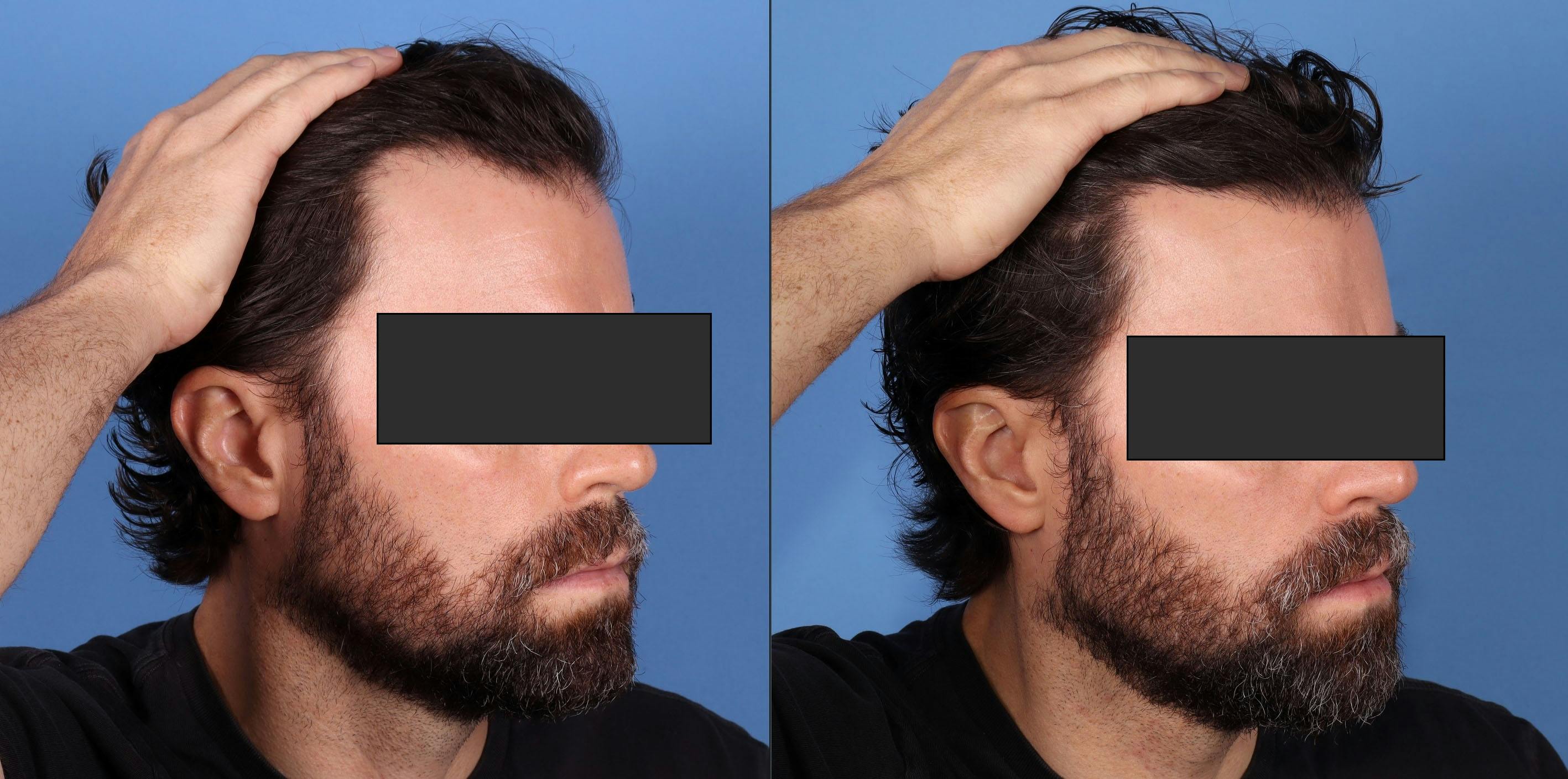 NeoGraft Hair Restoration Before & After Gallery - Patient 386851 - Image 5