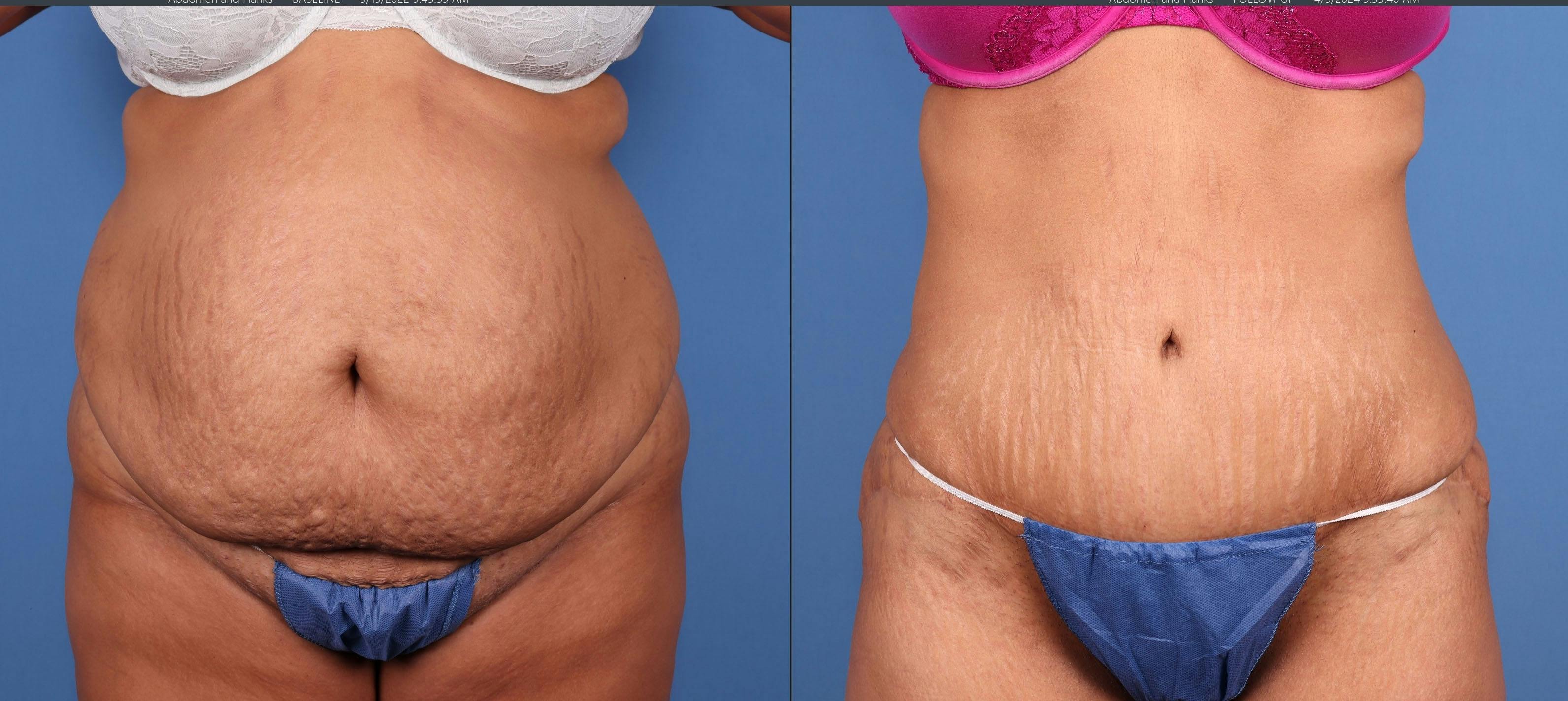 Abdomen Before & After Gallery - Patient 368417 - Image 1