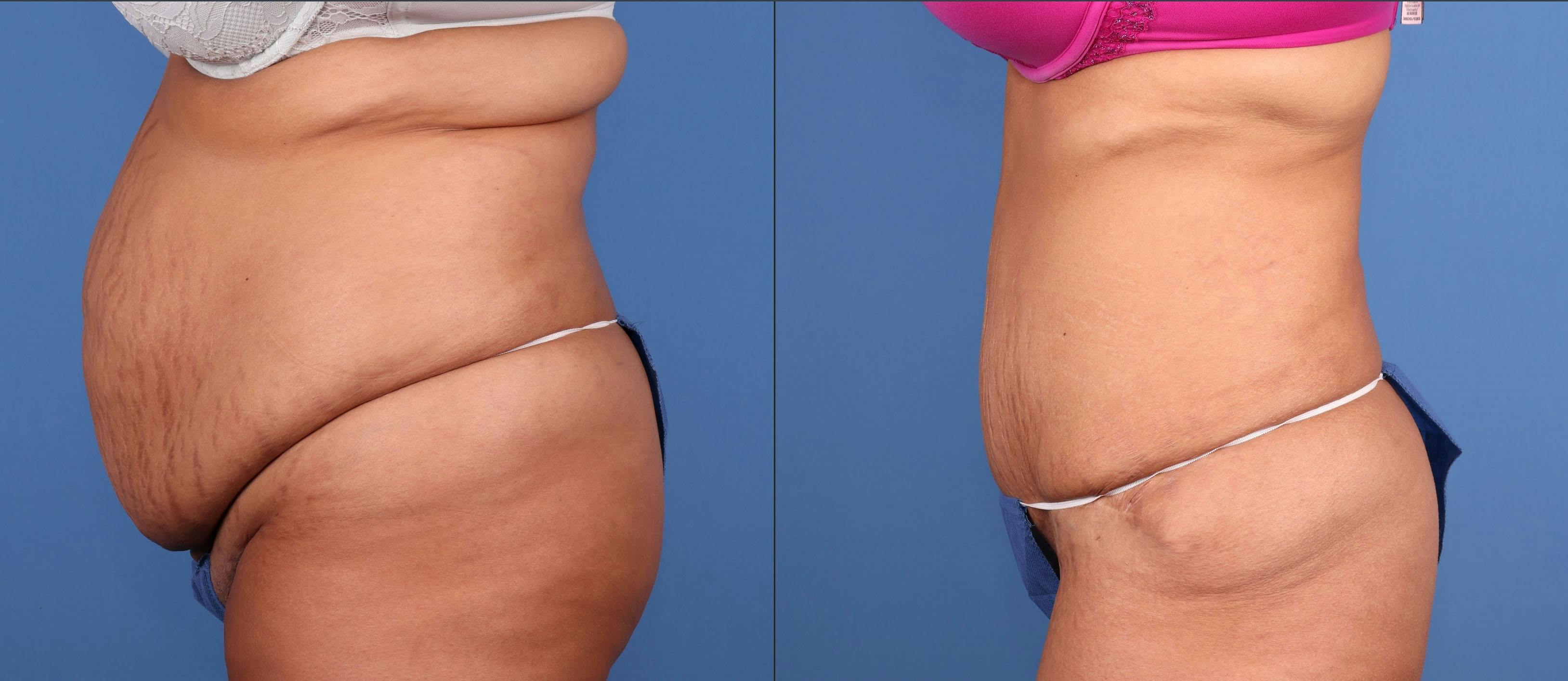 Abdomen Before & After Gallery - Patient 368417 - Image 3