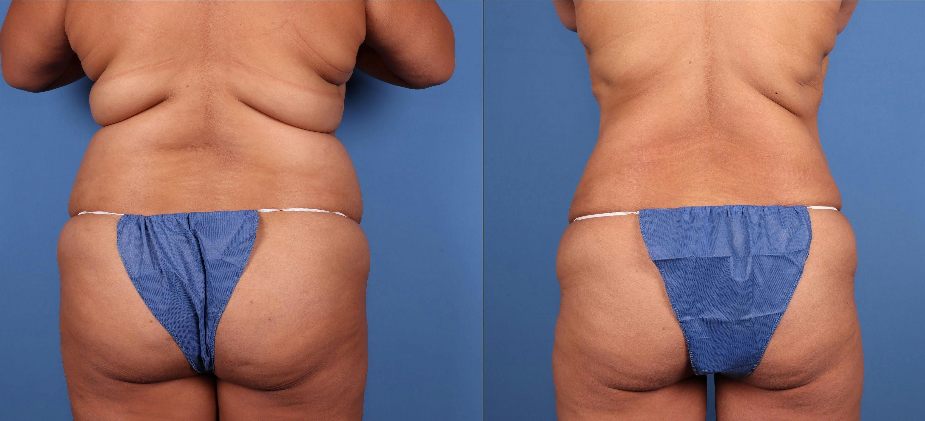 Tummy Tuck Before & After Gallery - Patient 320230 - Image 4