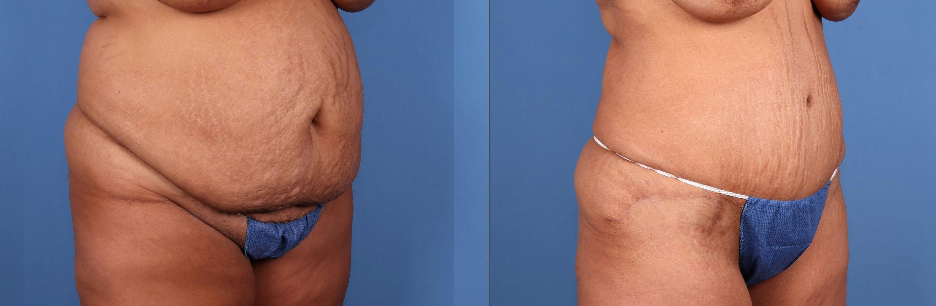 Tummy Tuck Before & After Gallery - Patient 403014 - Image 2