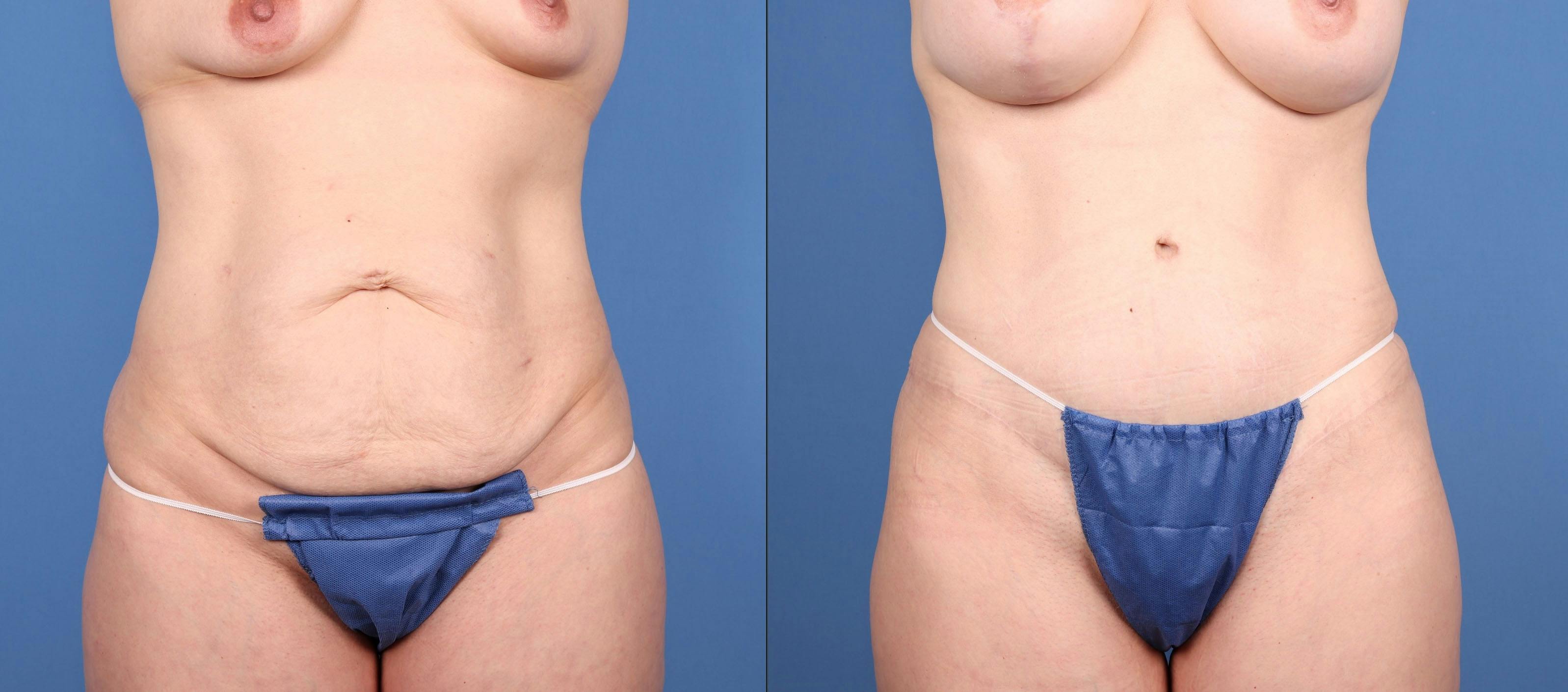 Tummy Tuck Before & After Gallery - Patient 277339 - Image 1