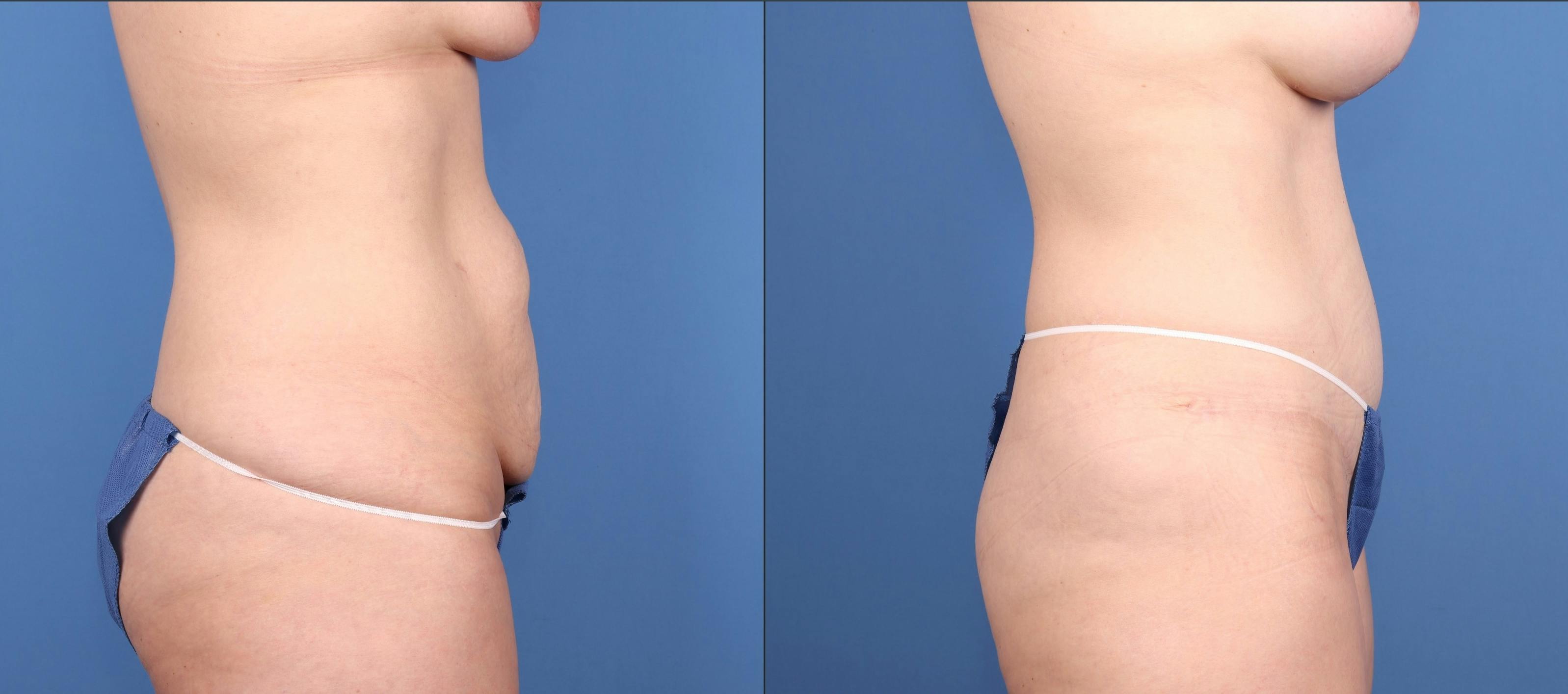 Tummy Tuck Before & After Gallery - Patient 277339 - Image 3