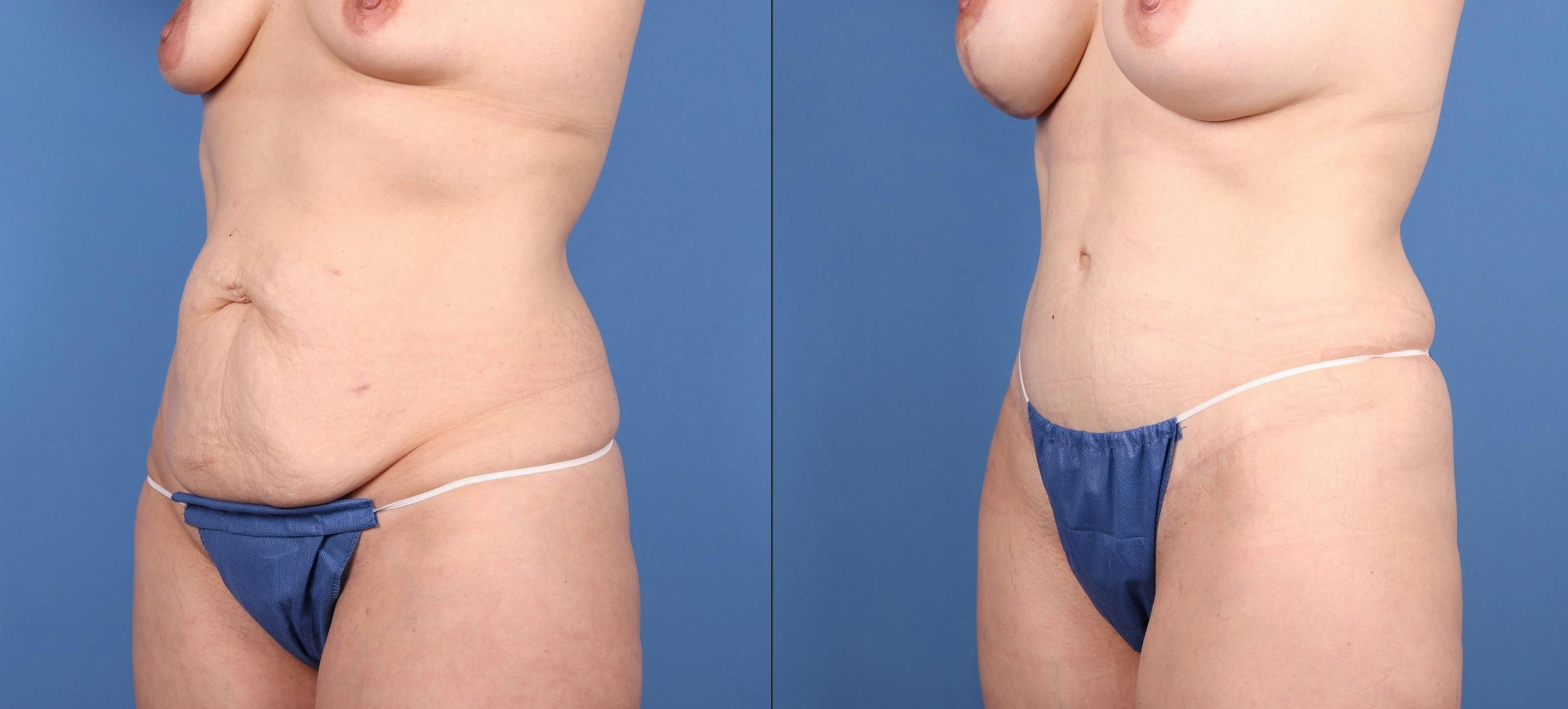 Tummy Tuck Before & After Gallery - Patient 277339 - Image 2