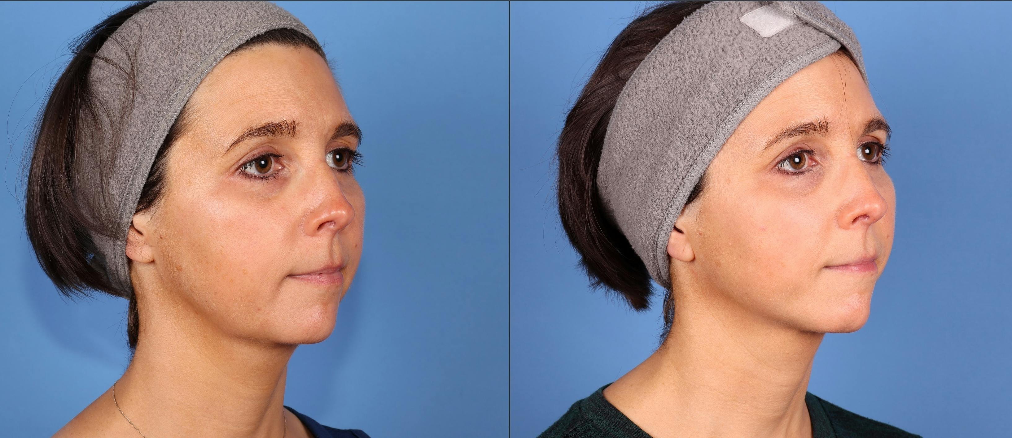 Face & Neck Before & After Gallery - Patient 354121 - Image 2