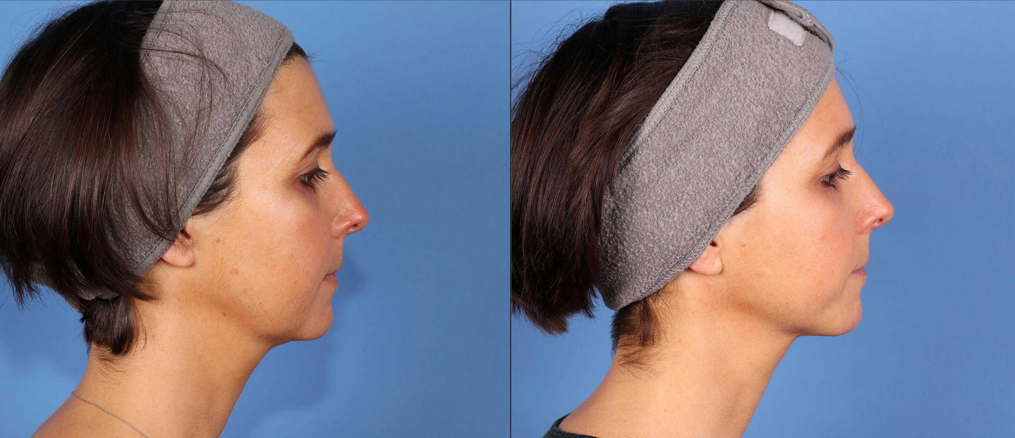 Face & Neck Before & After Gallery - Patient 354121 - Image 3