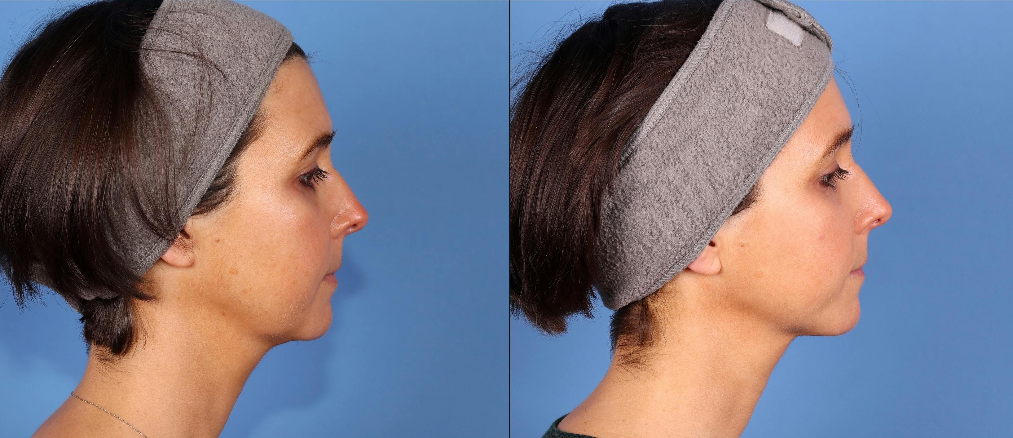Face Before & After Gallery - Patient 354121 - Image 3