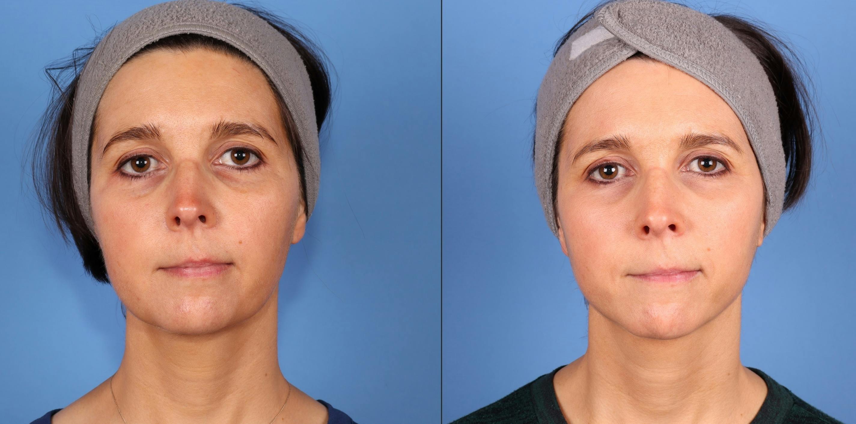 Face Before & After Gallery - Patient 354121 - Image 1