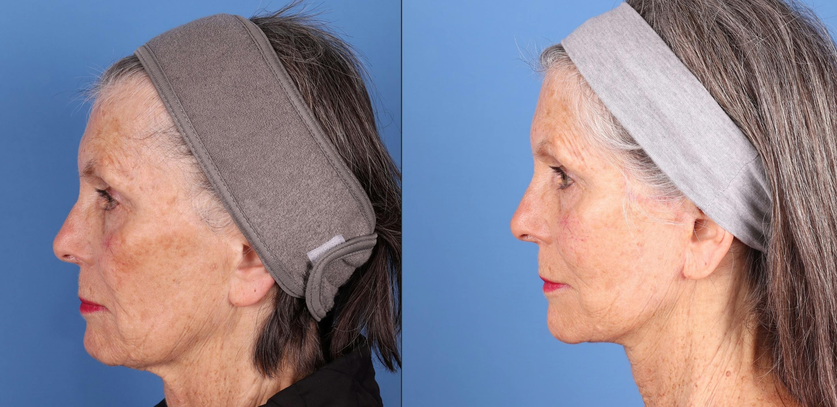 Face Lift Before & After Gallery - Patient 134323 - Image 5