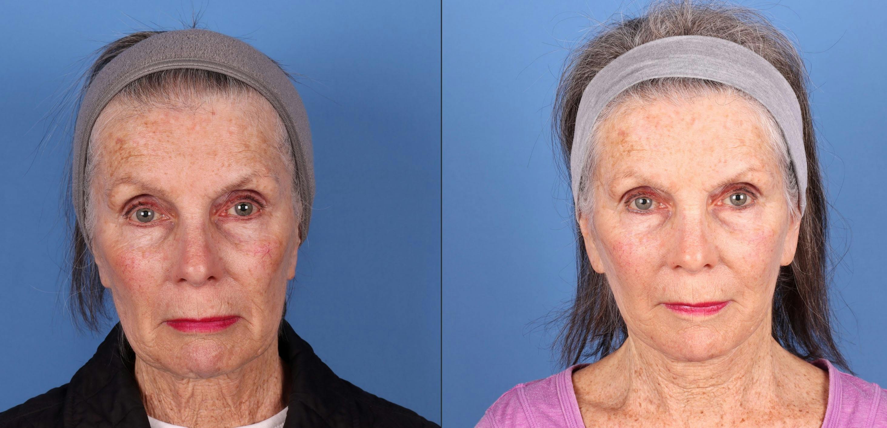 Face Lift Before & After Gallery - Patient 134323 - Image 1