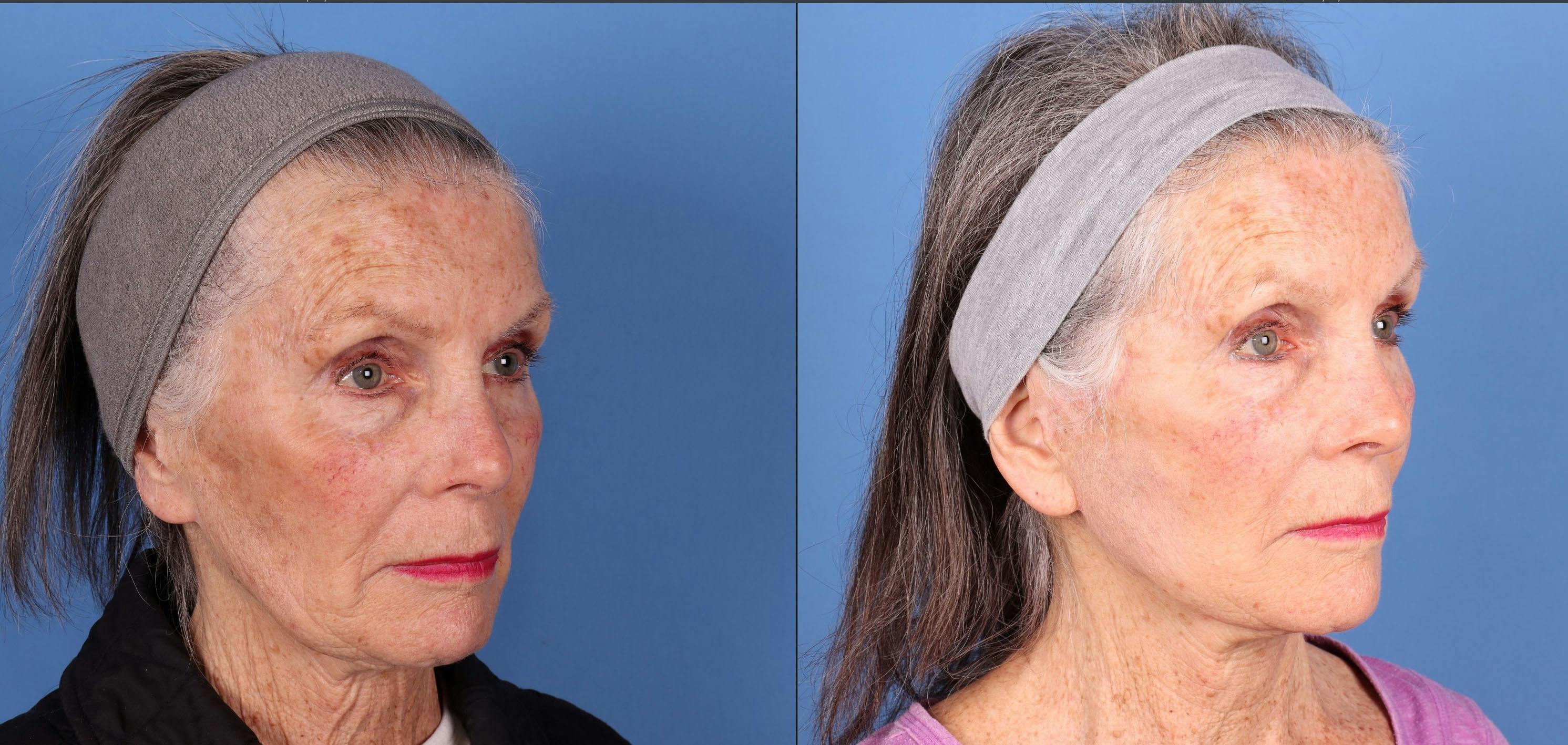 Face Lift Before & After Gallery - Patient 134323 - Image 2