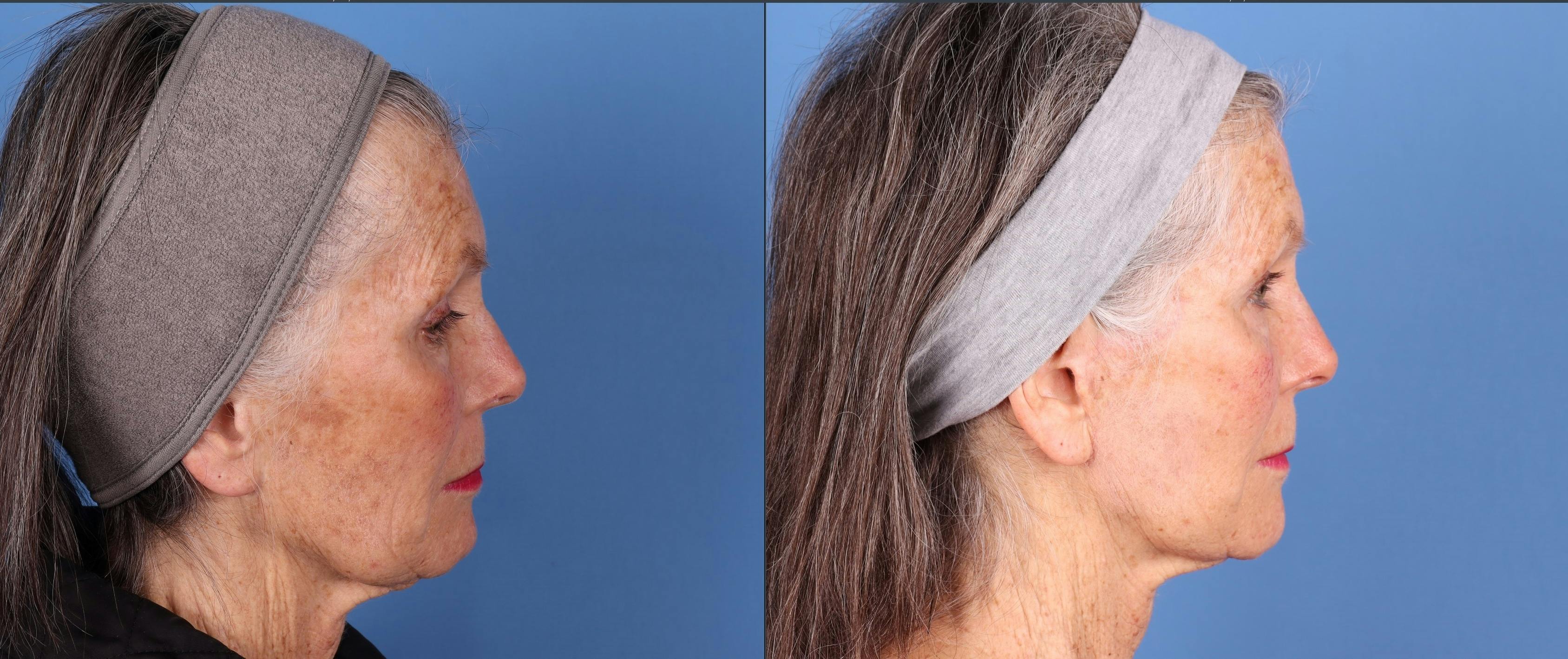 Face Lift Before & After Gallery - Patient 134323 - Image 3