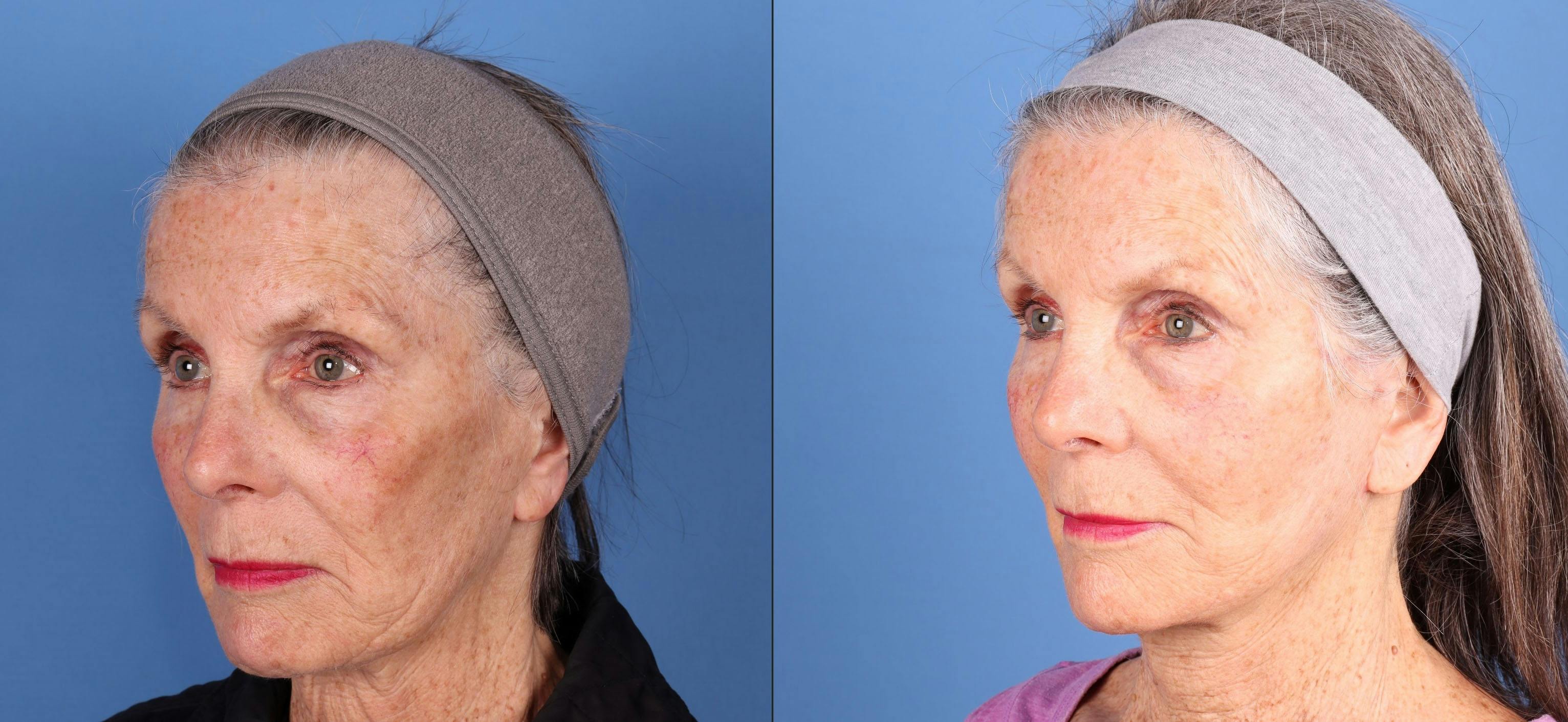 Face Lift Before & After Gallery - Patient 134323 - Image 4