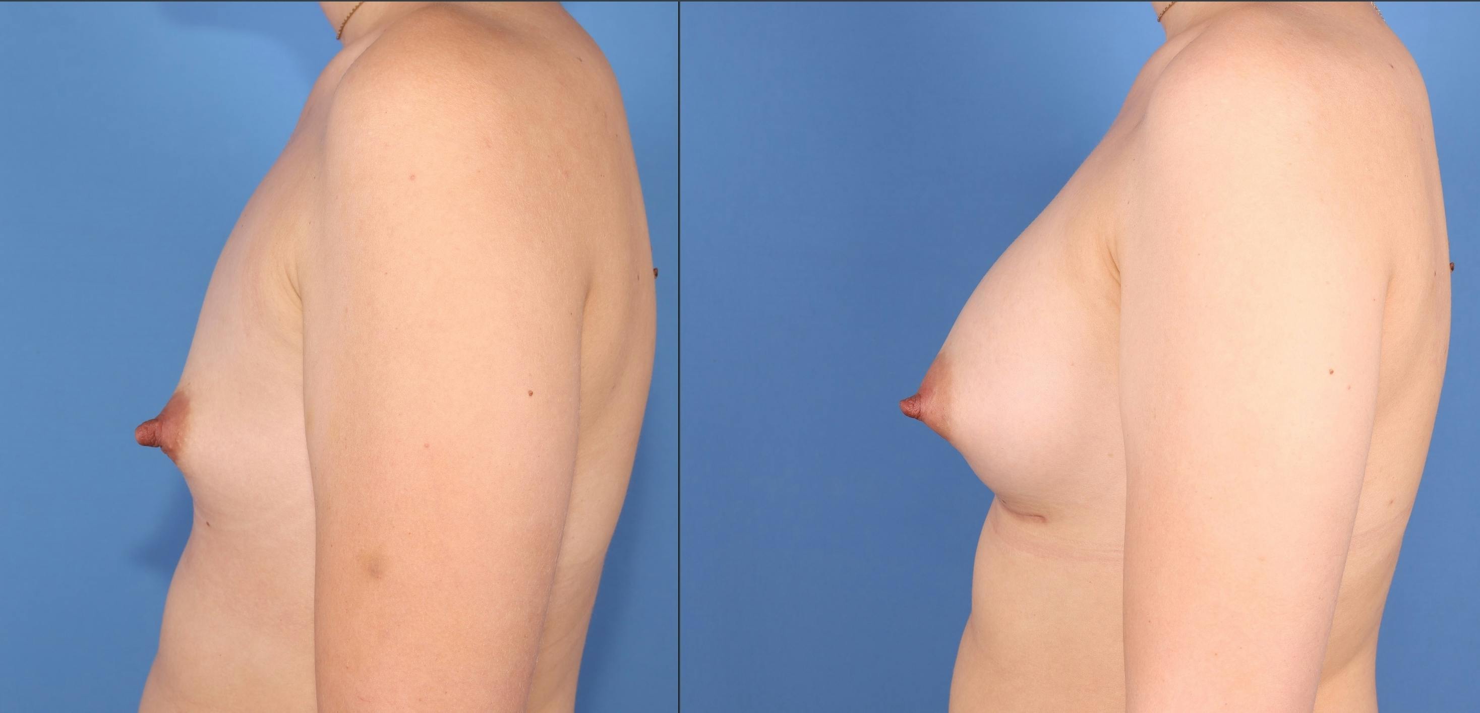 Breast Augmentation Before & After Gallery - Patient 320181 - Image 3