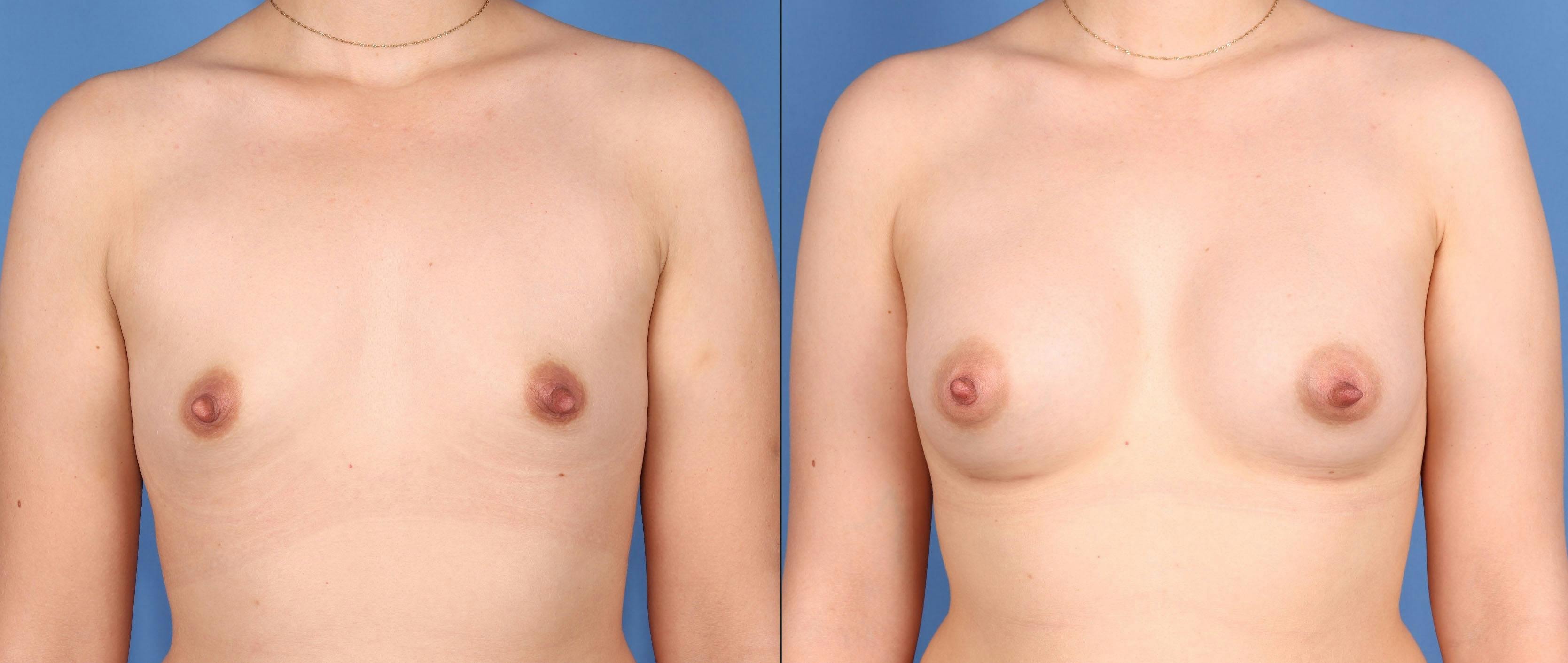 Breast Augmentation Before & After Gallery - Patient 320181 - Image 1