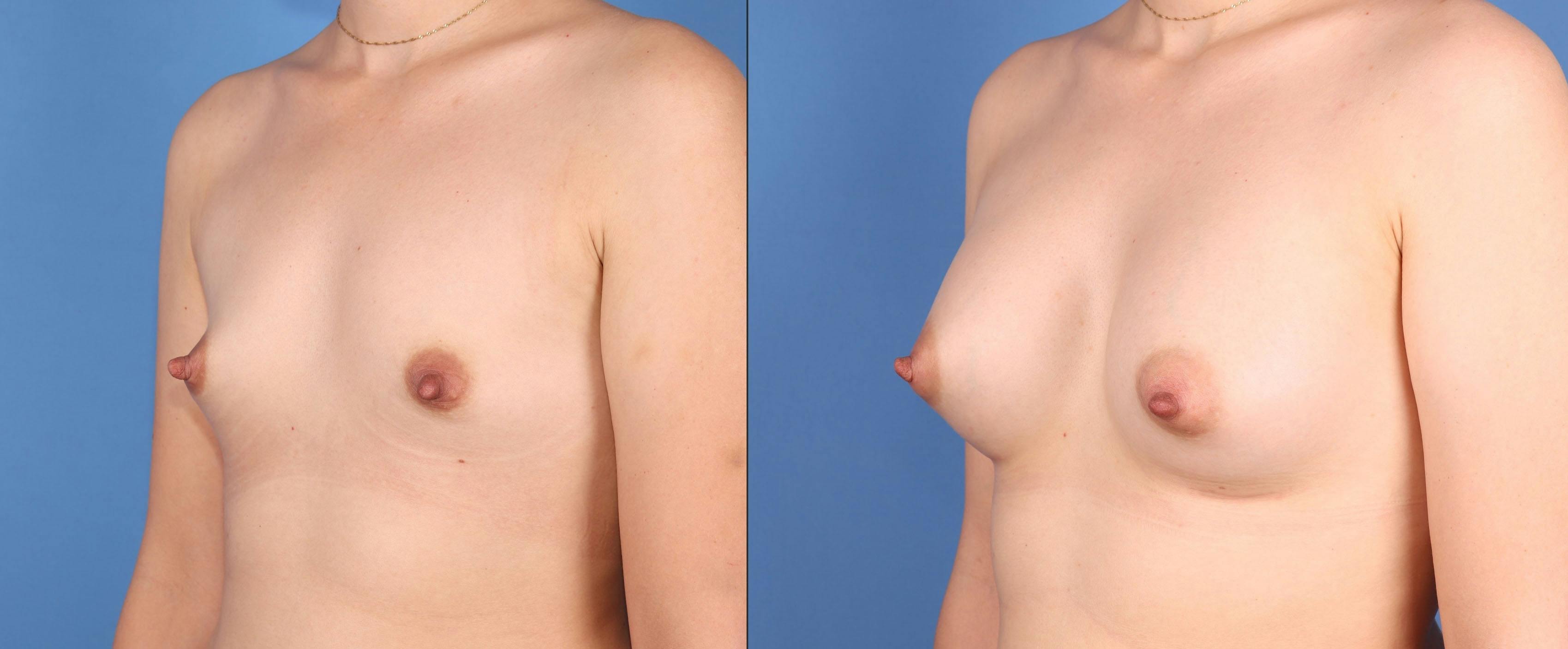 Breast Augmentation Before & After Gallery - Patient 320181 - Image 2