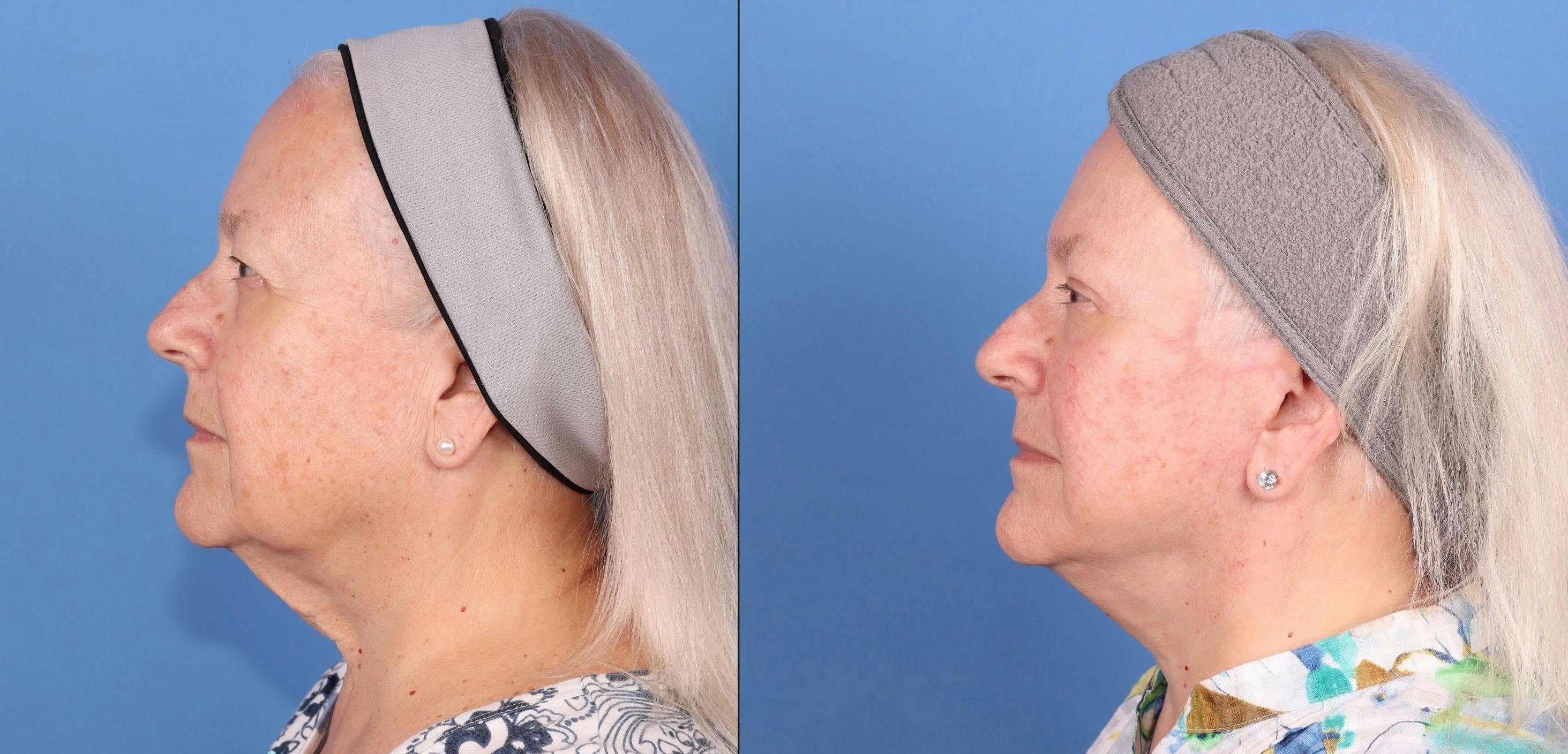 Eyelid Surgery (Upper Blepharoplasty) Before & After Gallery - Patient 291440 - Image 3