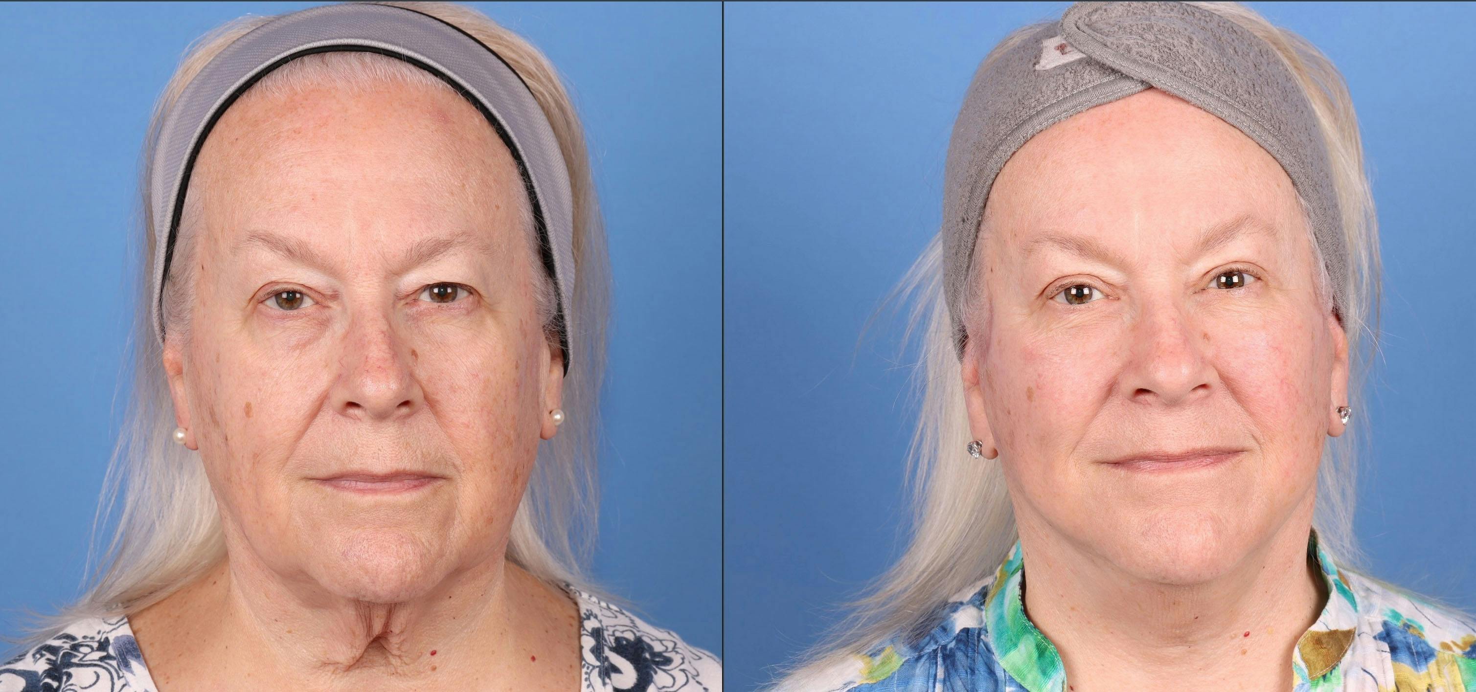 Eyelid Surgery (Upper Blepharoplasty) Before & After Gallery - Patient 291440 - Image 1