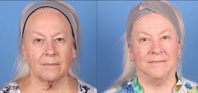 Eyelid Surgery (Upper Blepharoplasty) Before & After Gallery - Patient 291440 - Image 1