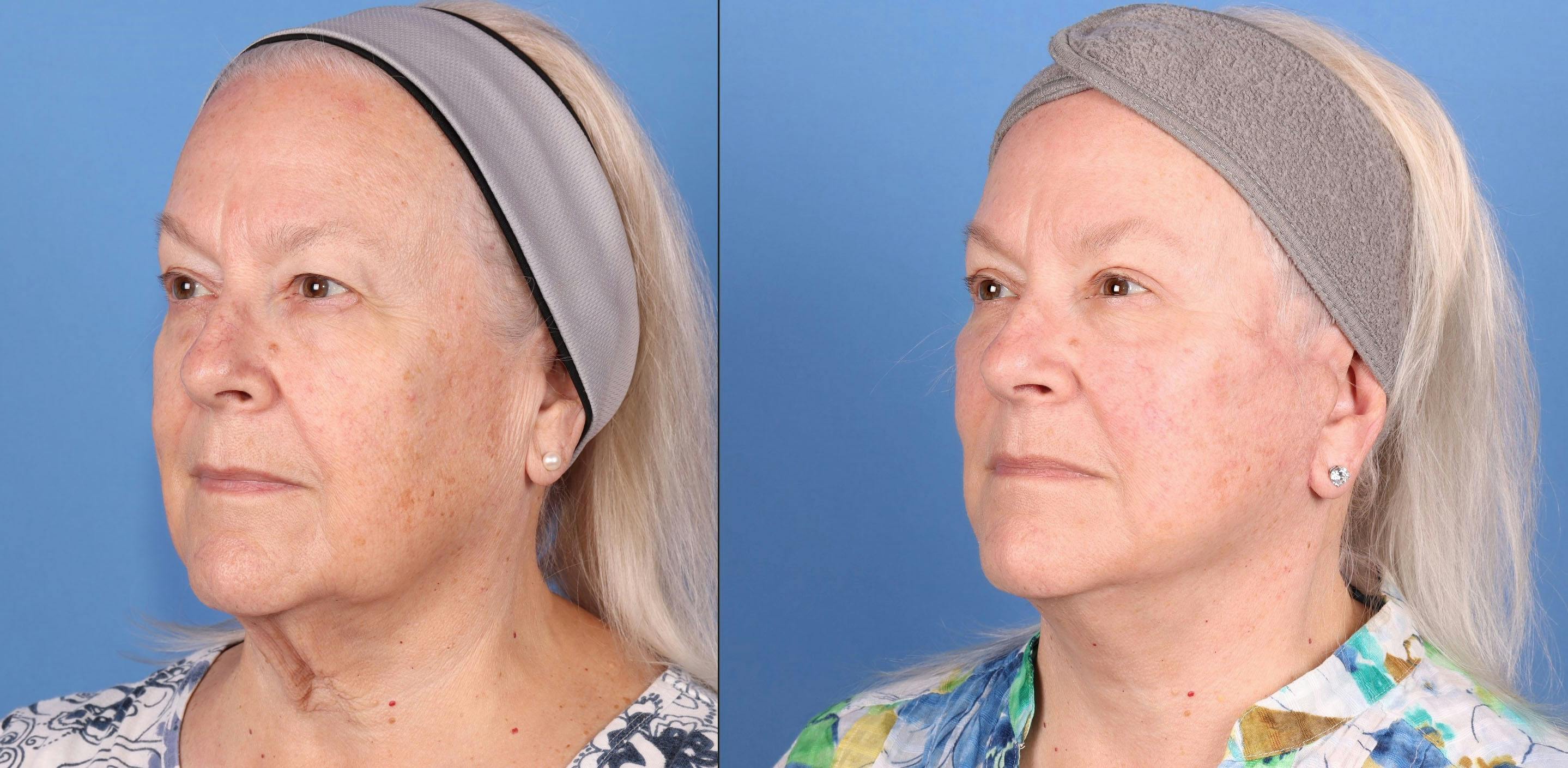 Eyelid Surgery (Upper Blepharoplasty) Before & After Gallery - Patient 291440 - Image 2