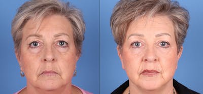 Eyelid Surgery (Upper & Lower Blepharoplasty) Before & After Gallery - Patient 290371 - Image 1