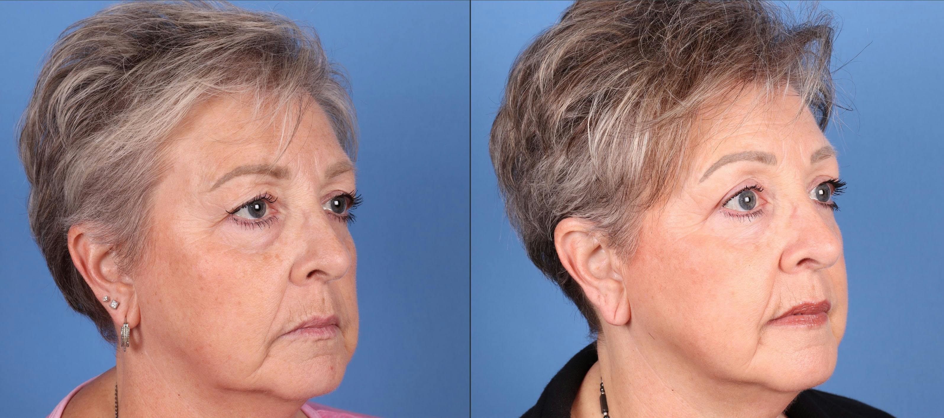 Eyelid Surgery (Upper & Lower Blepharoplasty) Before & After Gallery - Patient 290371 - Image 2