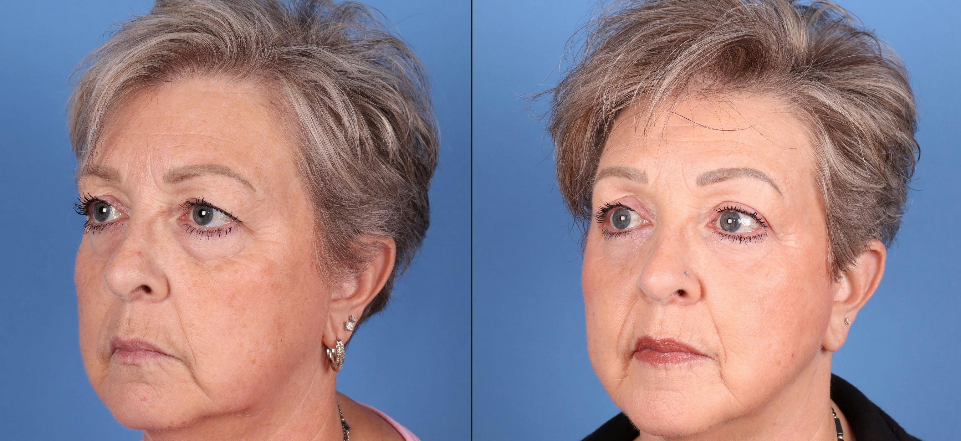 Eyelid Surgery (Upper & Lower Blepharoplasty) Before & After Gallery - Patient 290371 - Image 3