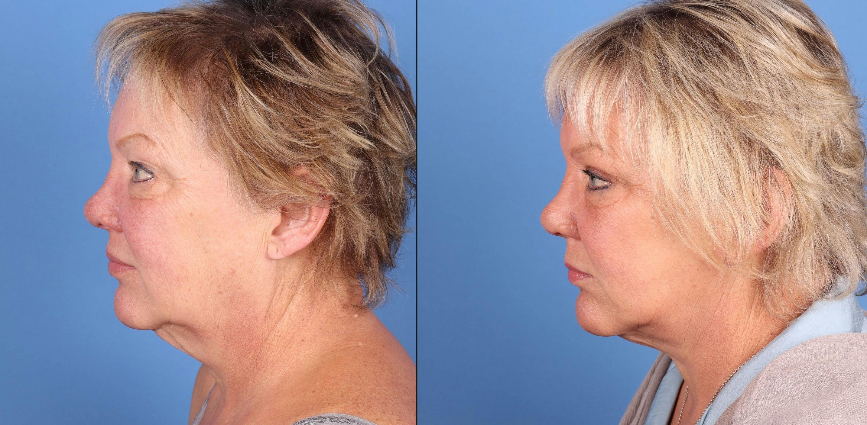 Mini Facelift Before & After Gallery - Patient 424904 - Image 3