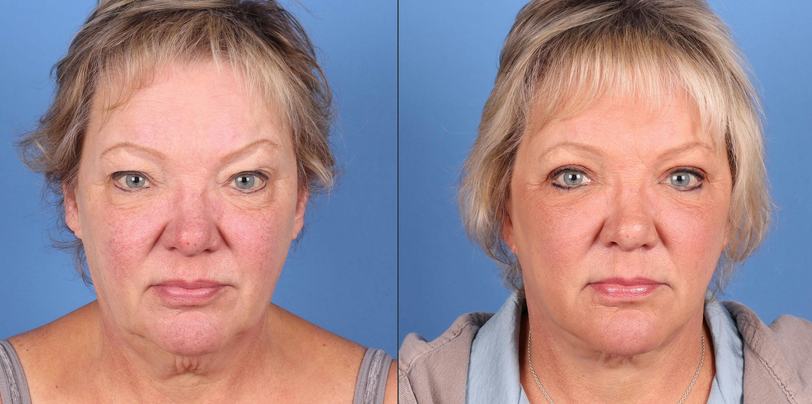 Mini Facelift Before & After Gallery - Patient 424904 - Image 1
