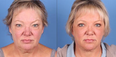 Eyelid Surgery (Upper Blepharoplasty) Before & After Gallery - Patient 511910 - Image 1