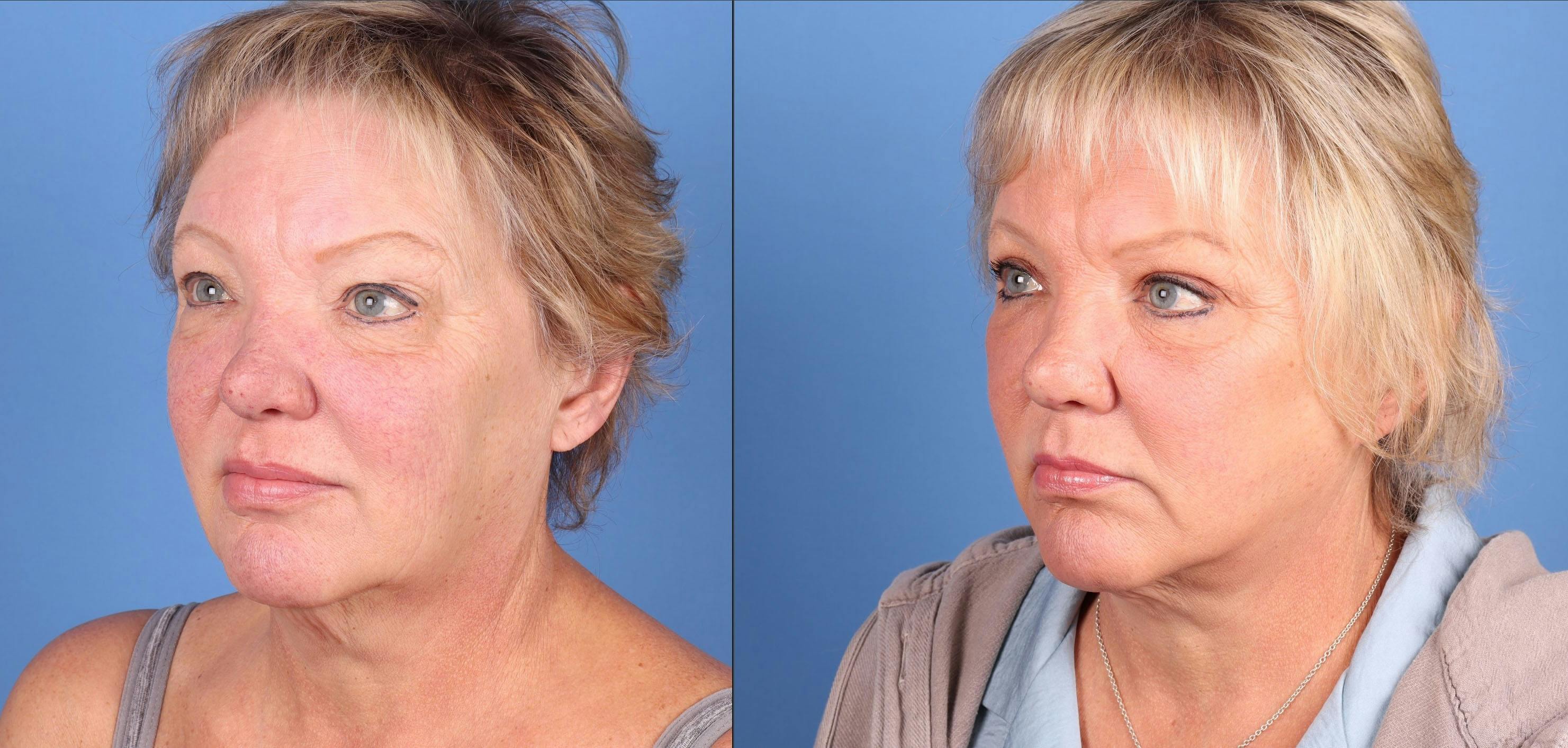 Mini Facelift Before & After Gallery - Patient 424904 - Image 2