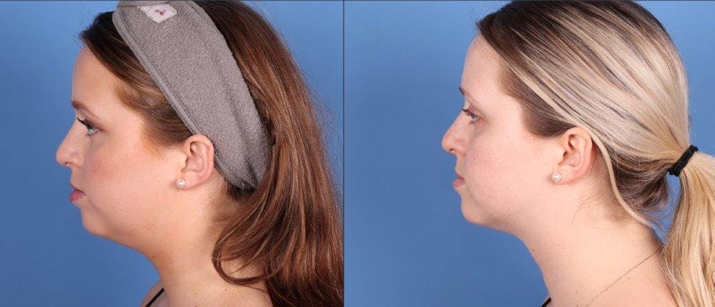 Face Before & After Gallery - Patient 320776 - Image 5