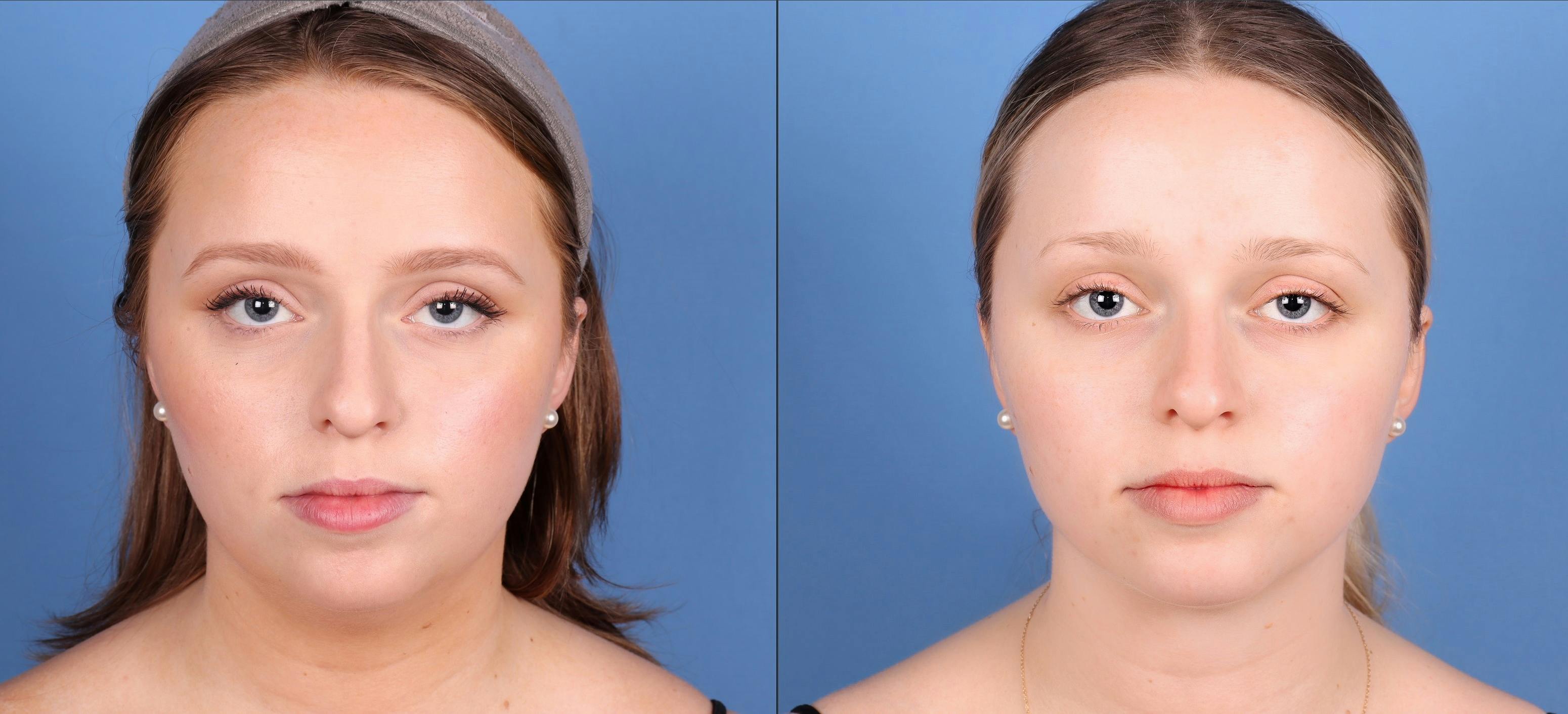 Face & Neck Before & After Gallery - Patient 320776 - Image 1