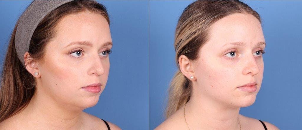 Face & Neck Before & After Gallery - Patient 320776 - Image 2
