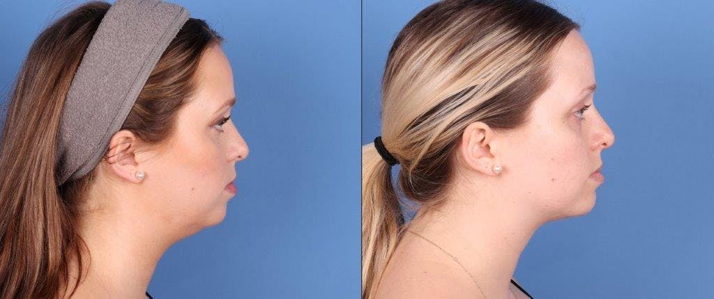 Face & Neck Before & After Gallery - Patient 320776 - Image 3
